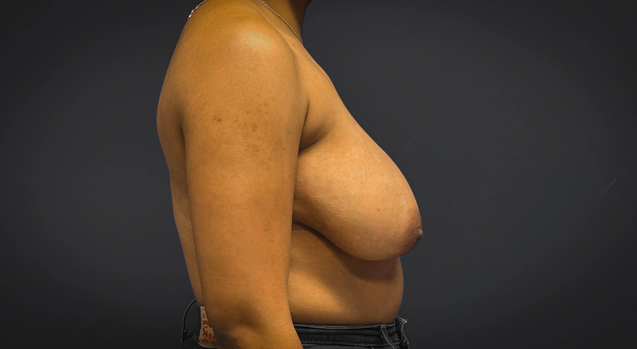 Breast-Reduction-Case--7089 | Before Breast 2