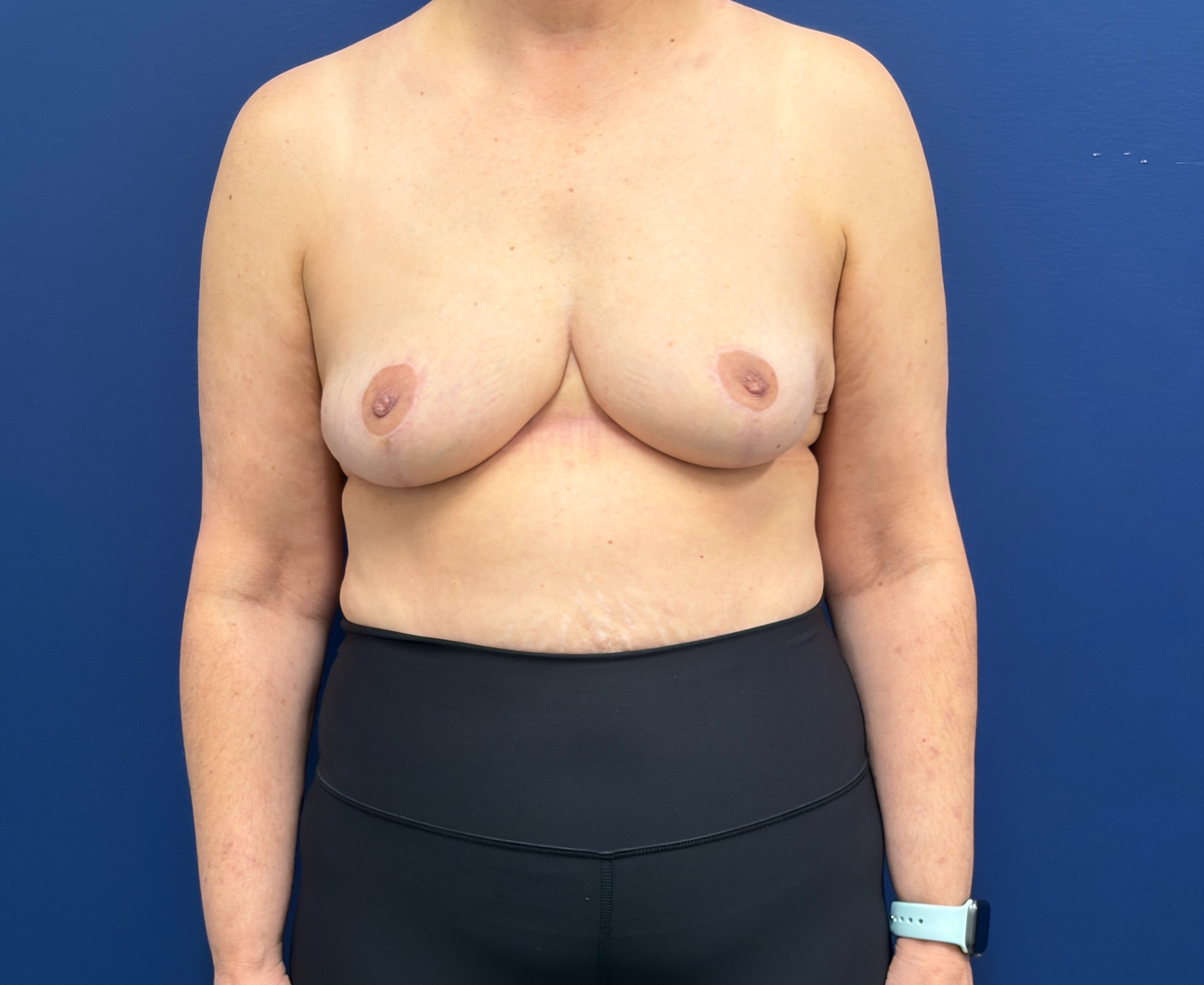 Breast-Reduction-Case--7709 | After Breast 1