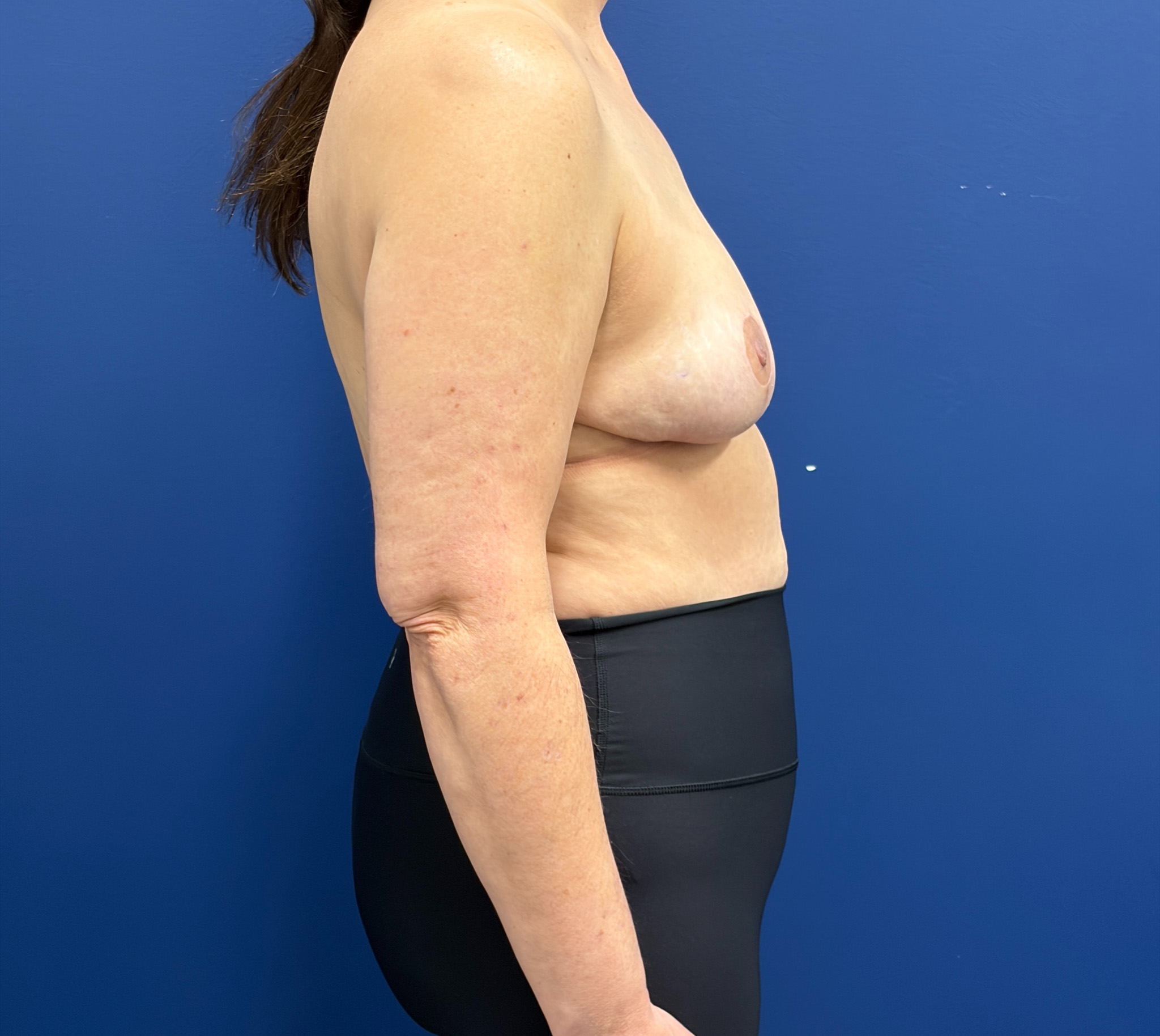 Breast-Reduction-Case--7709 | After Breast Reduction 3