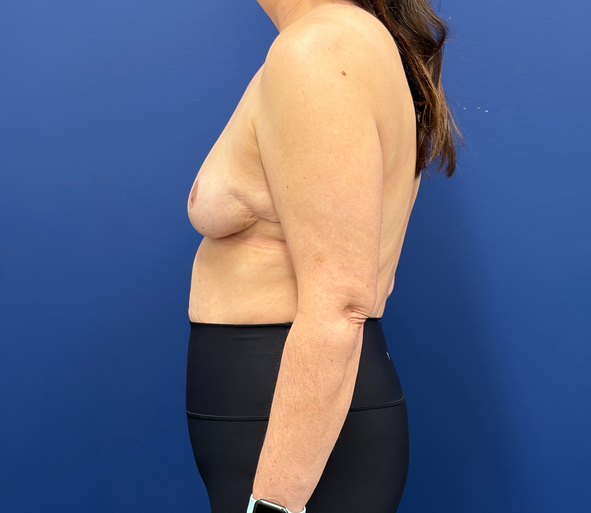 Breast-Reduction-Case--7709 | After Breast 2