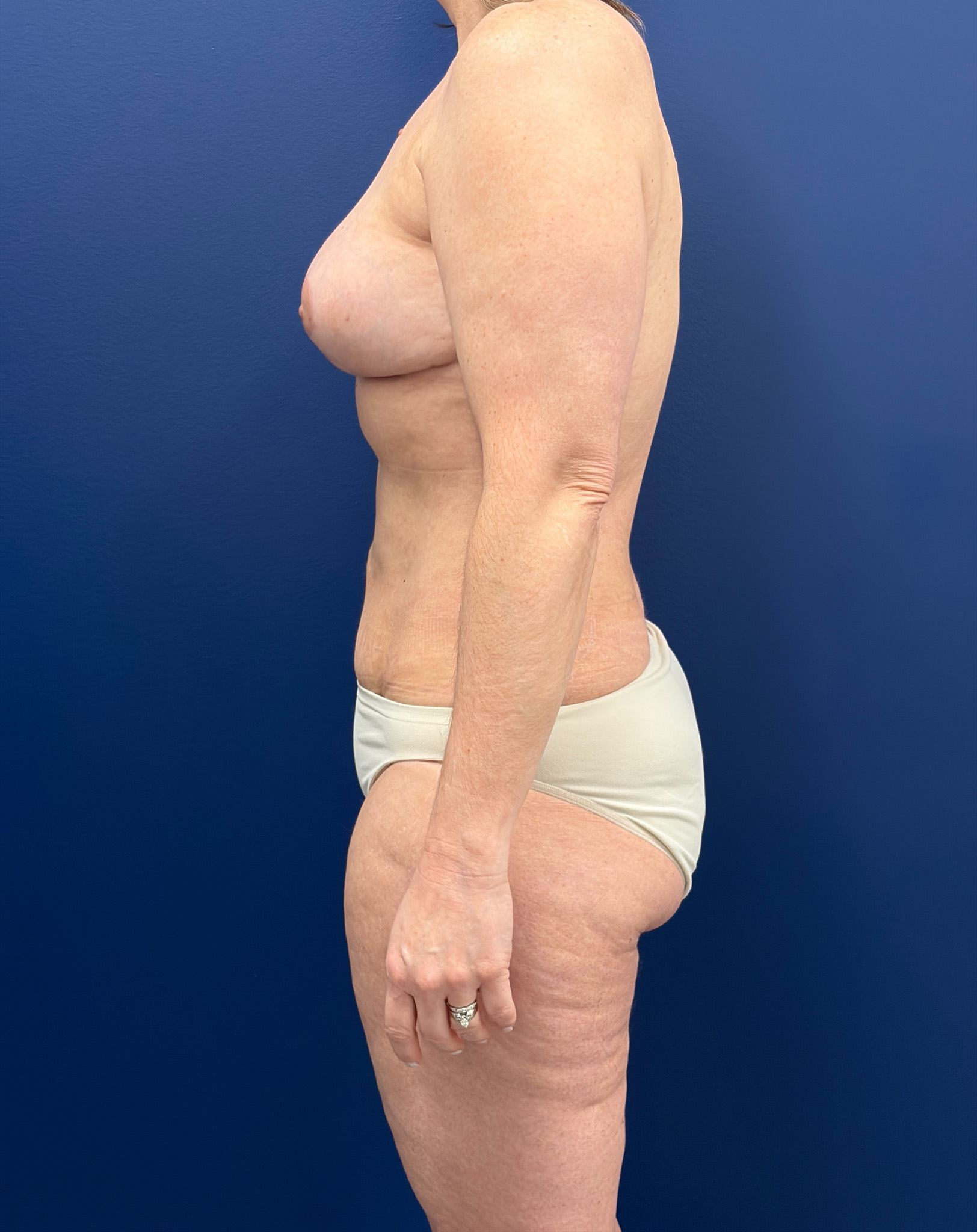 Mastopexy-with-Galaflex-Case--9485 | After Breast 2