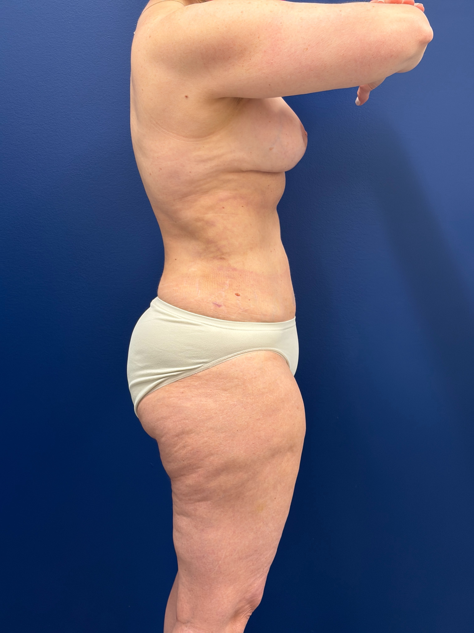 Mini-Lipoabdominoplasty-Case--9577 | After Tummy Tuck 2