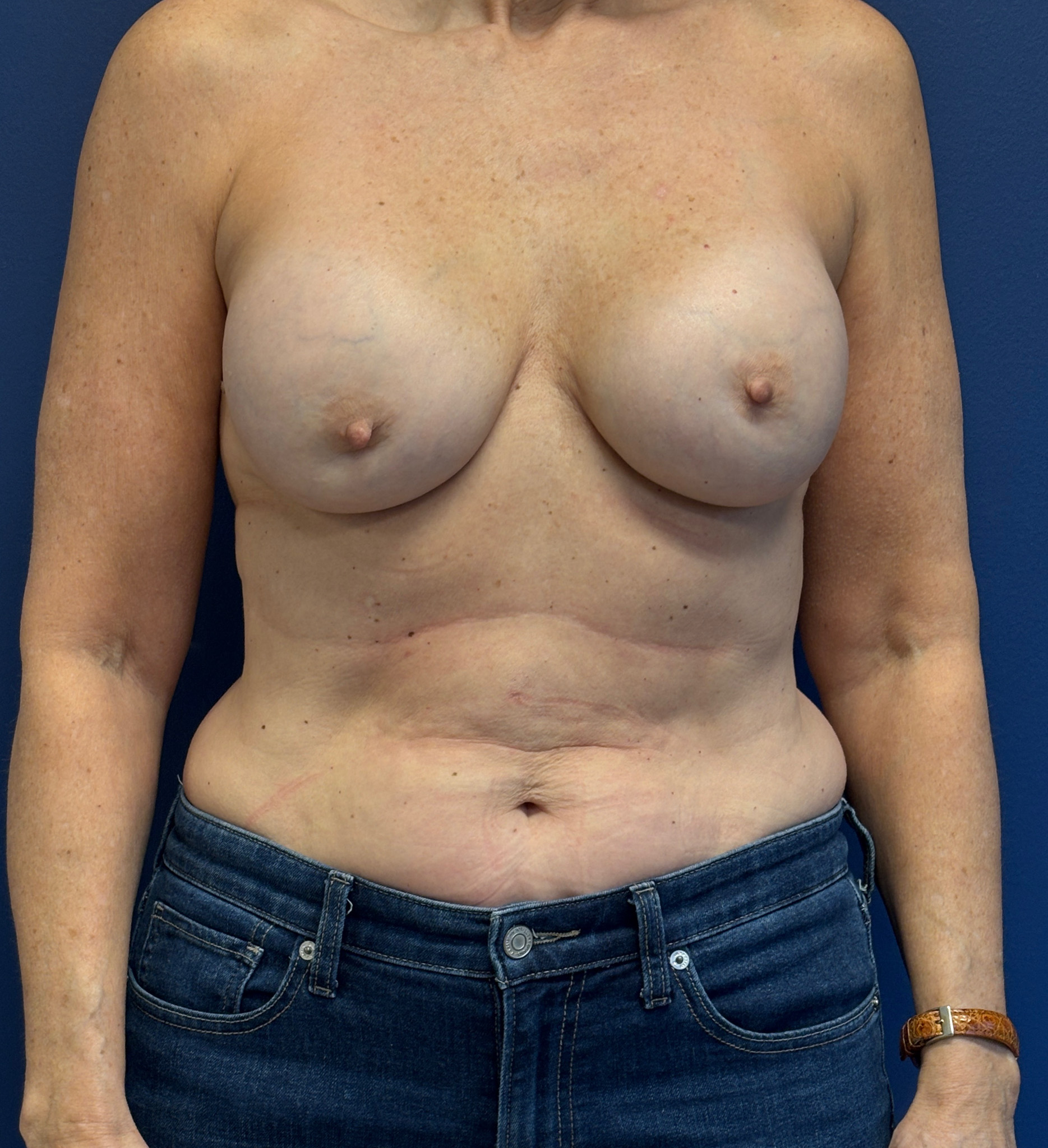Breast-Reconstruction-Case--4864 | Before Breast 1