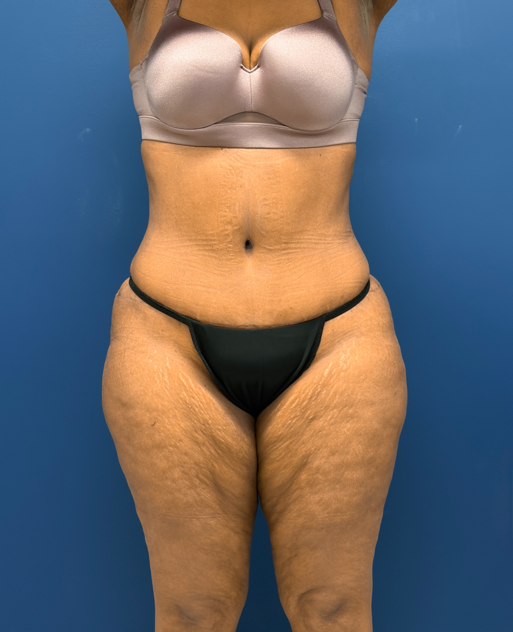 Lipoabdominoplasty-Case--6846 | After Tummy Tuck 1