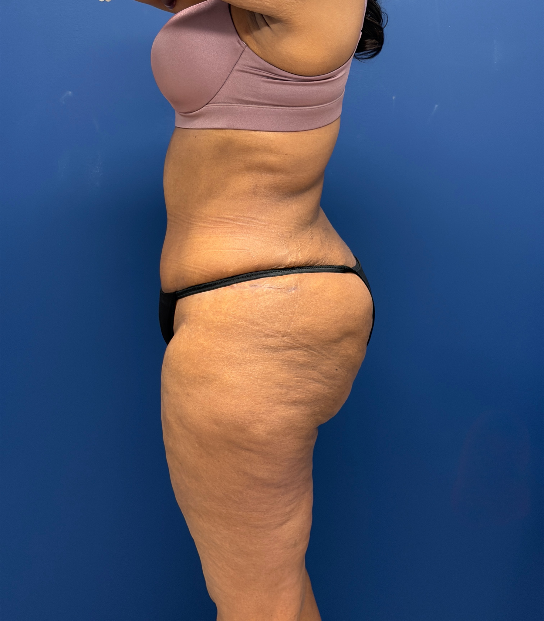 Lipoabdominoplasty-Case--6846 | After Tummy Tuck 2