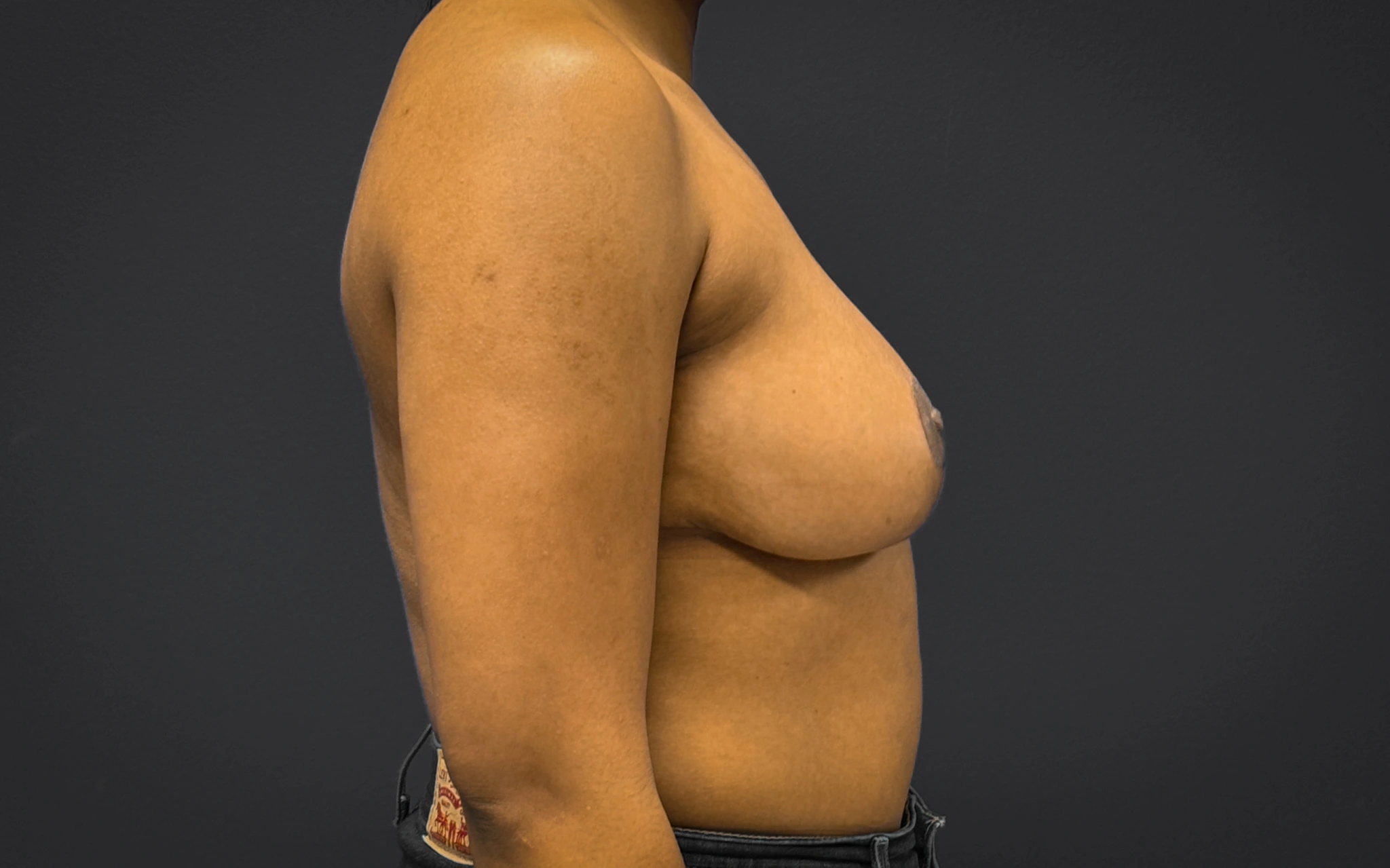 Breast-Reduction-Case--7089 | After Breast 2