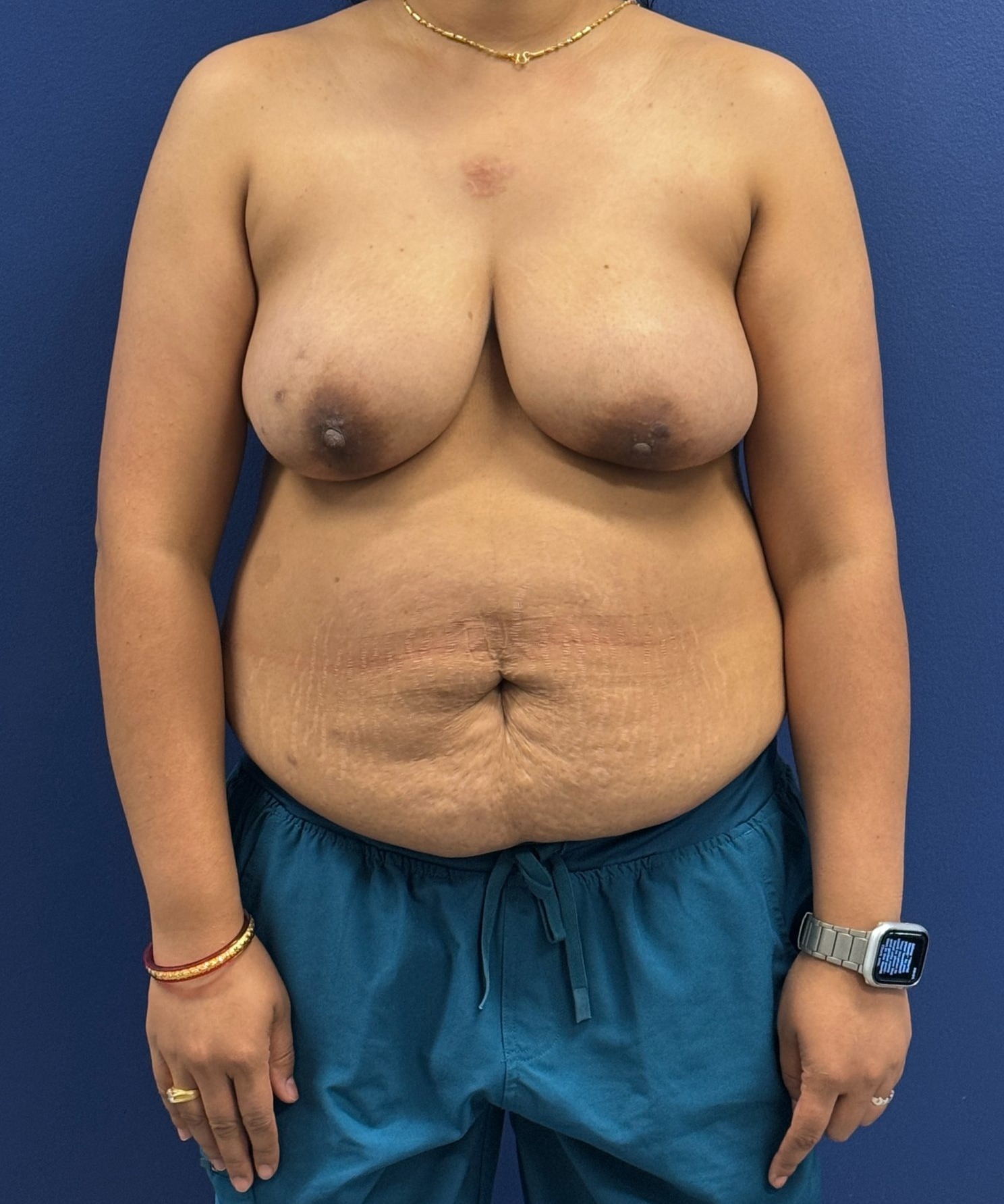 Nipple-Reconstruction-Case--1343 | Before Breast 1