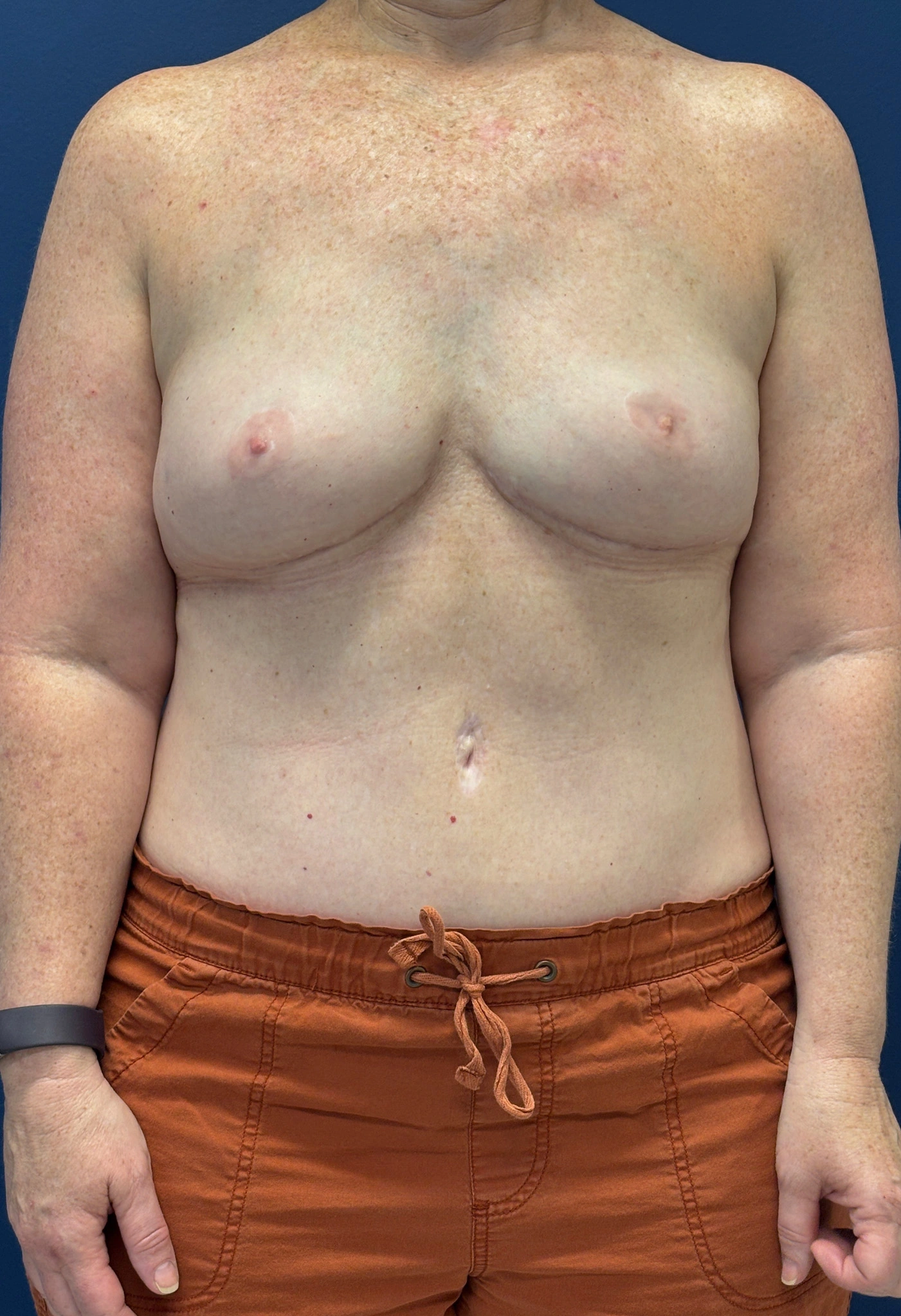 DIEP-Flap-Case--3138 | After Breast 1