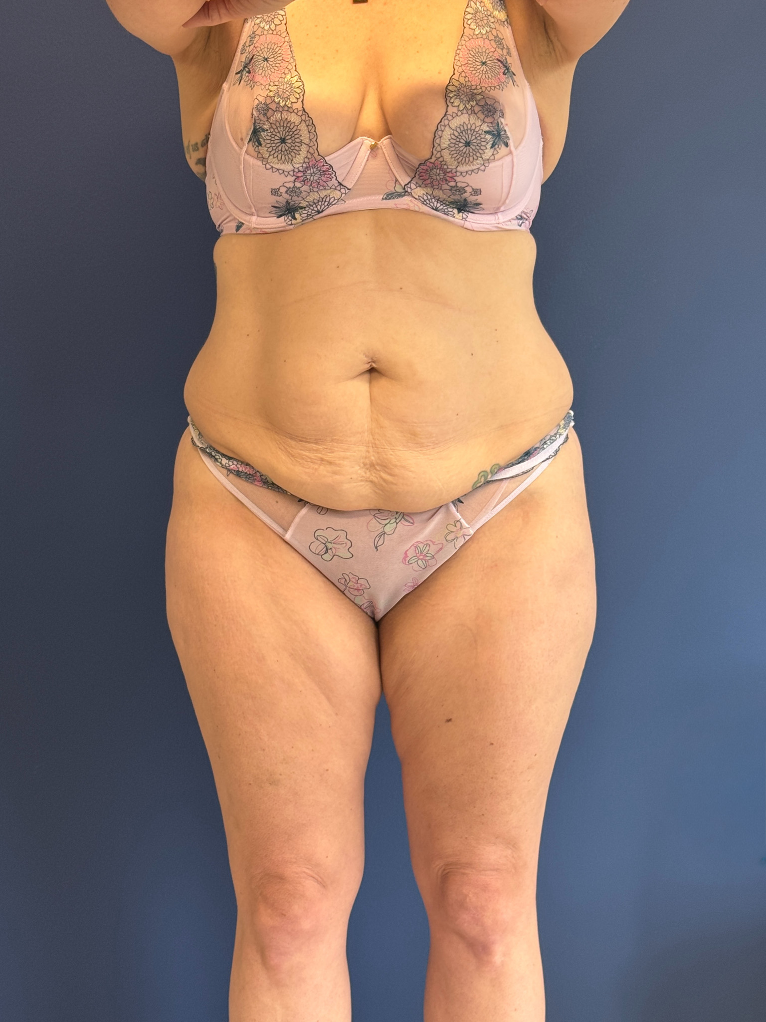 Abdominoplasty-Case--1856 | Before Tummy Tuck 1
