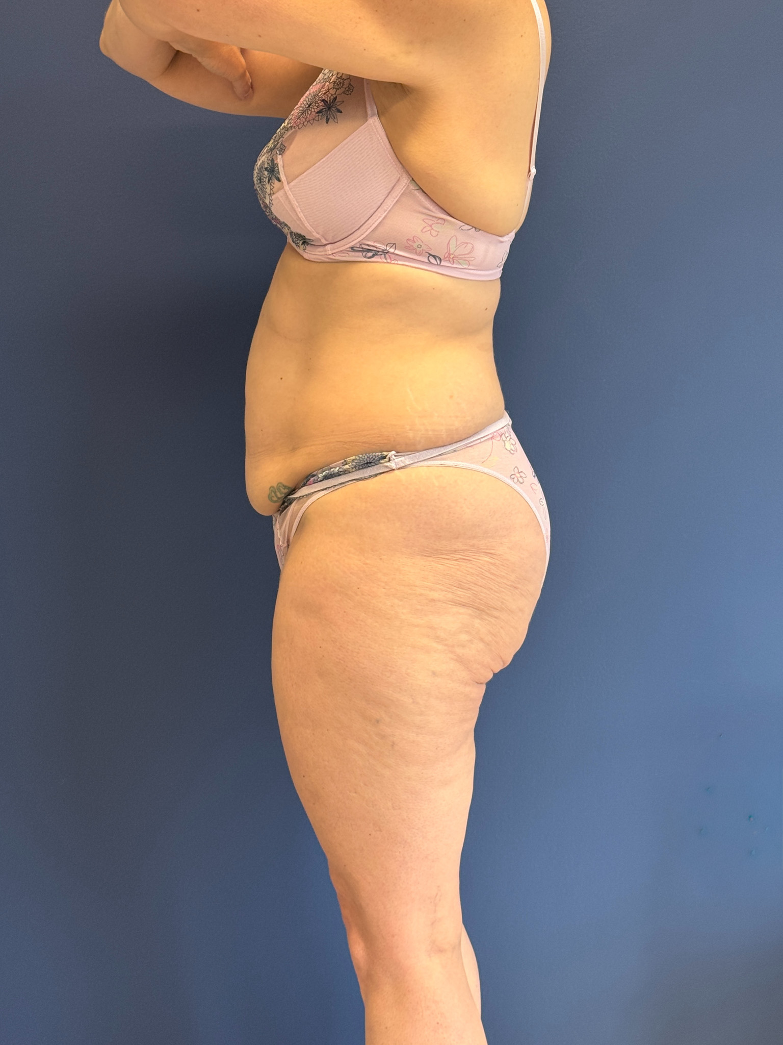 Abdominoplasty-Case--1856 | Before Tummy Tuck 3