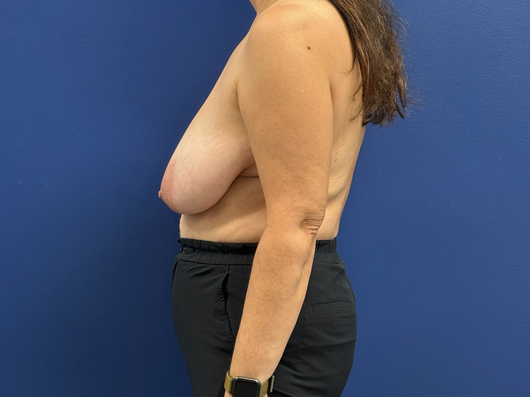 Breast-Reduction-Case--7709 | Before Breast 2