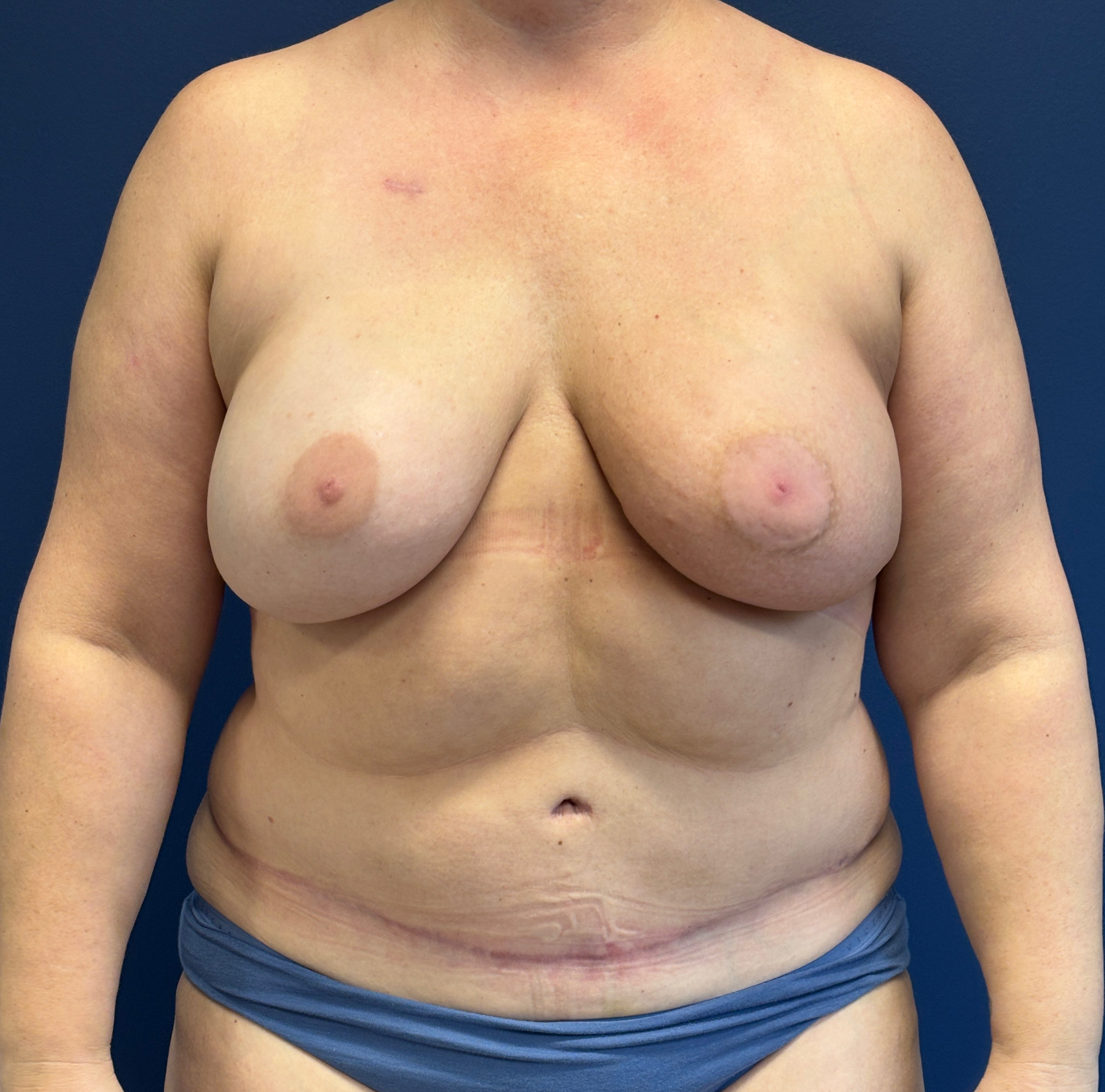 DIEP-Flap-Case--1682 | After Breast 1