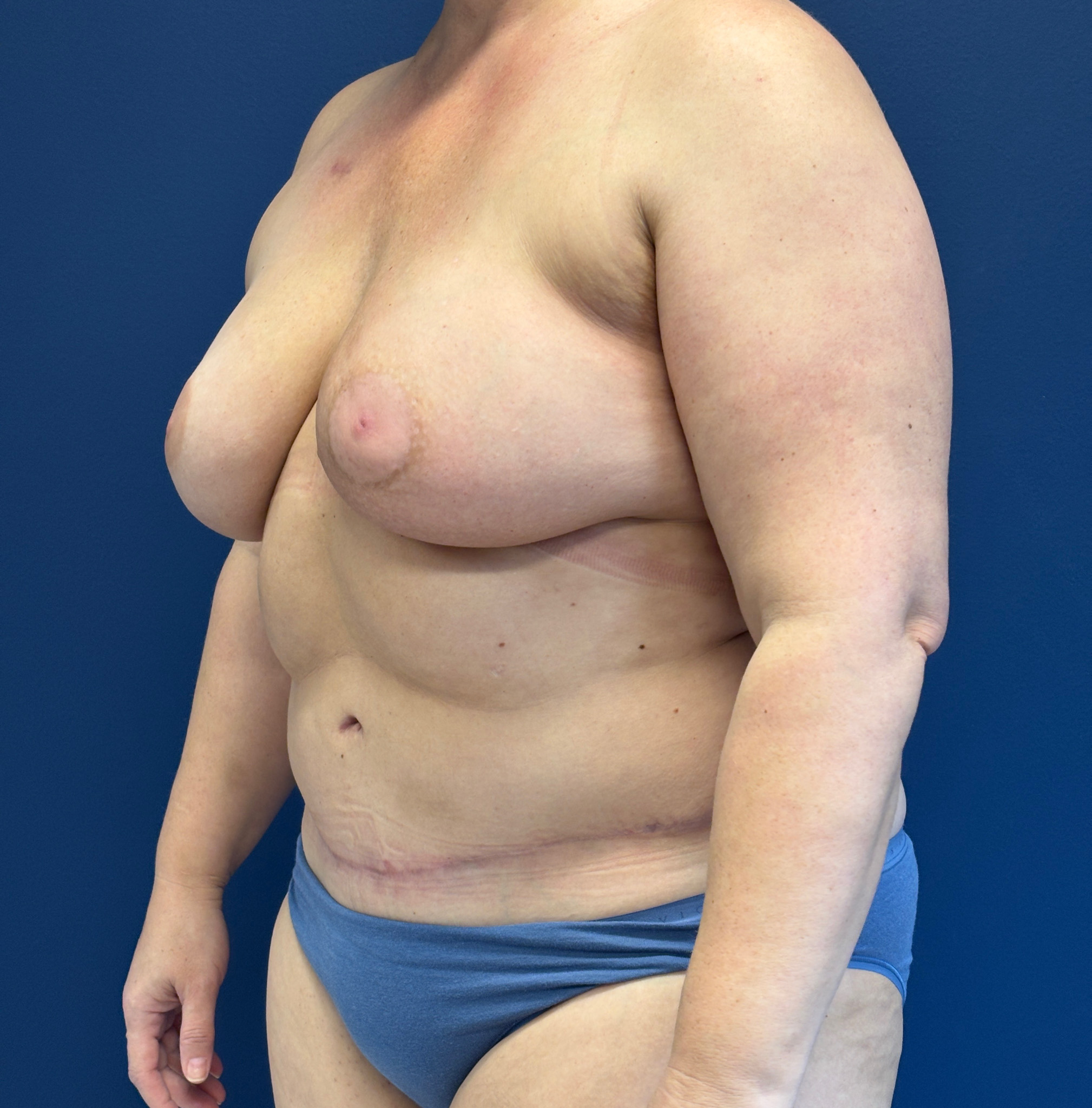 DIEP-Flap-Case--1682 | After Breast 2