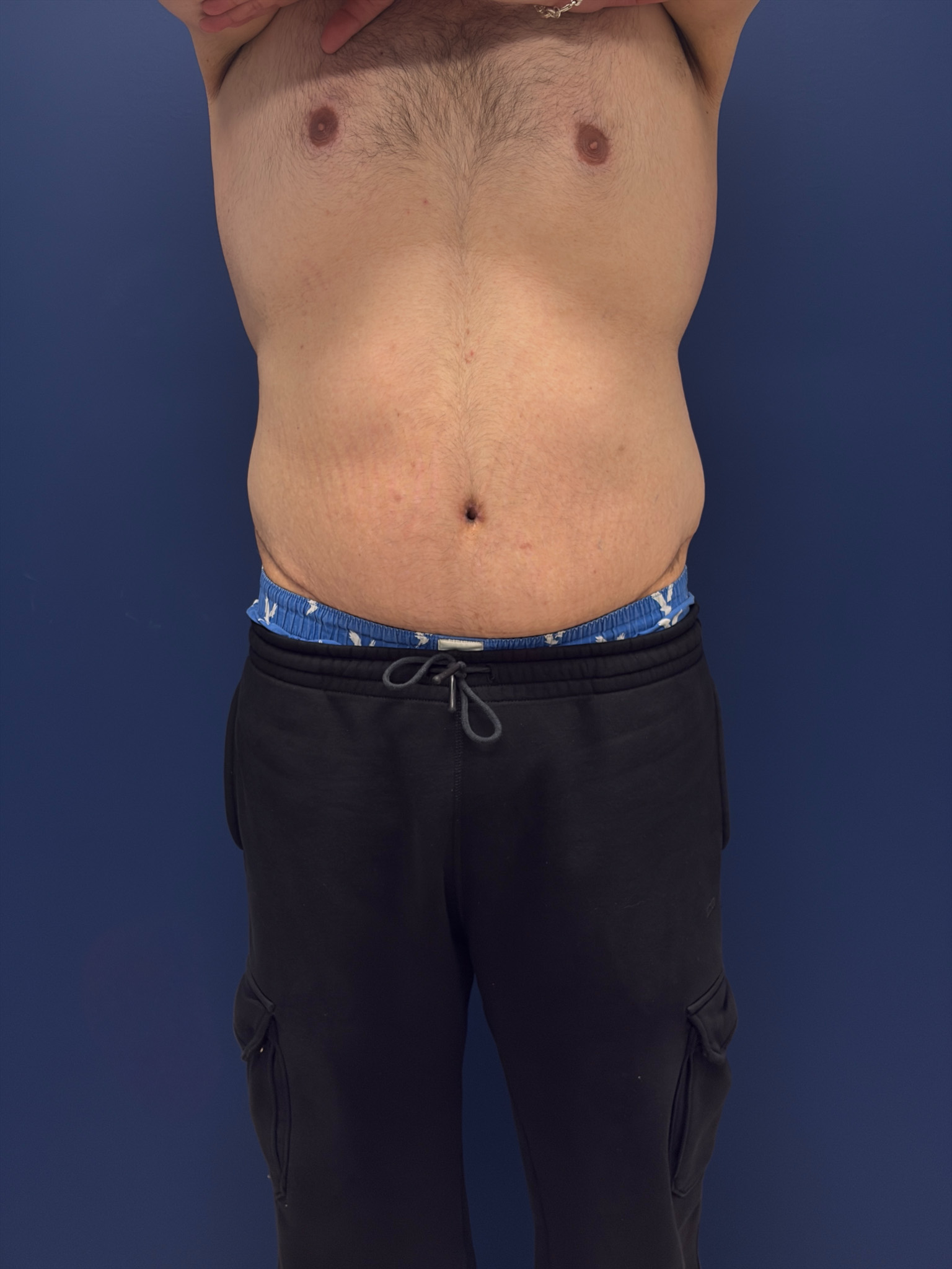 Body-Lift-Case--1927 | After Dr. Samir Rao 1