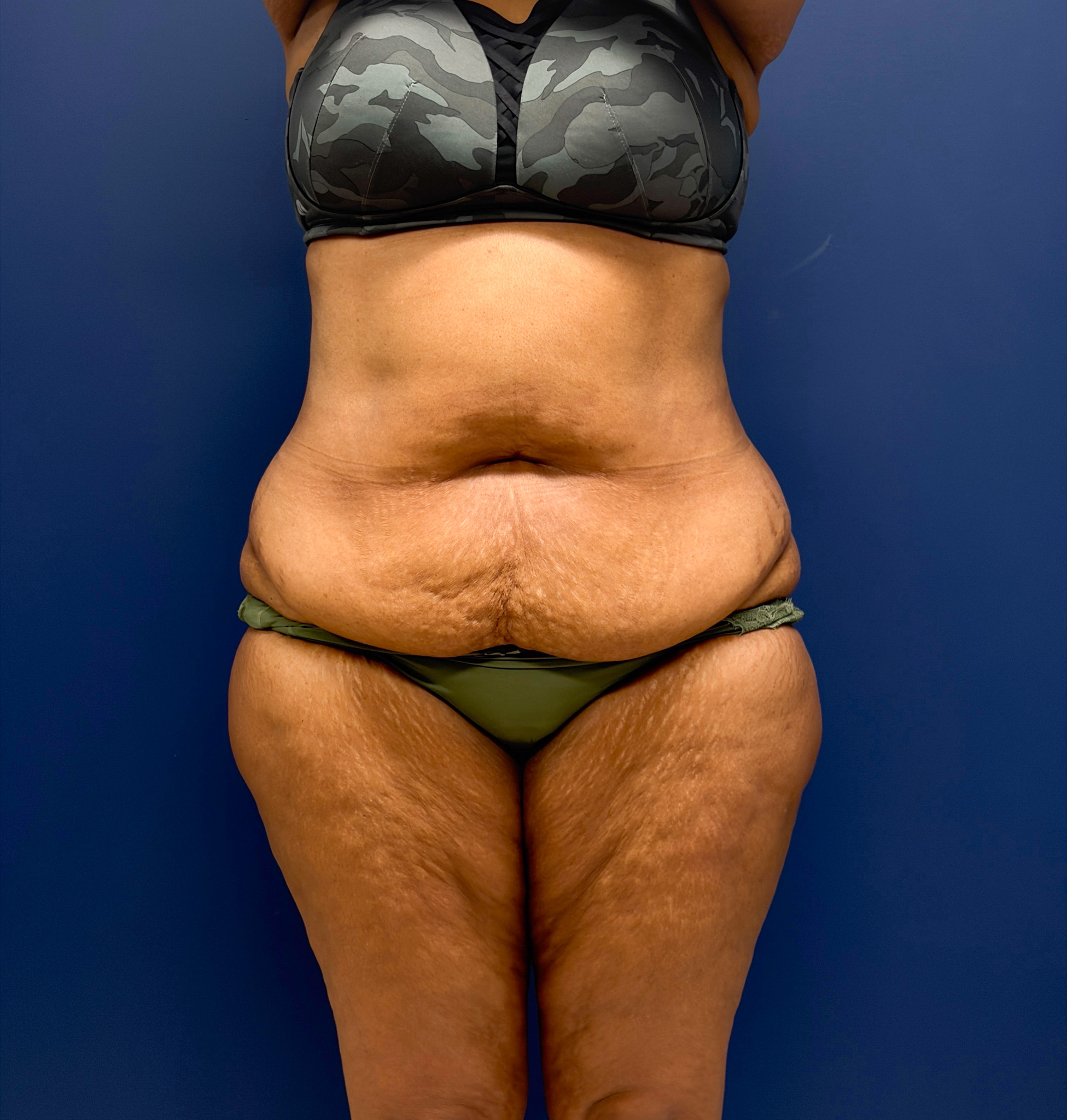 Lipoabdominoplasty-Case--6846 | Before Tummy Tuck 1