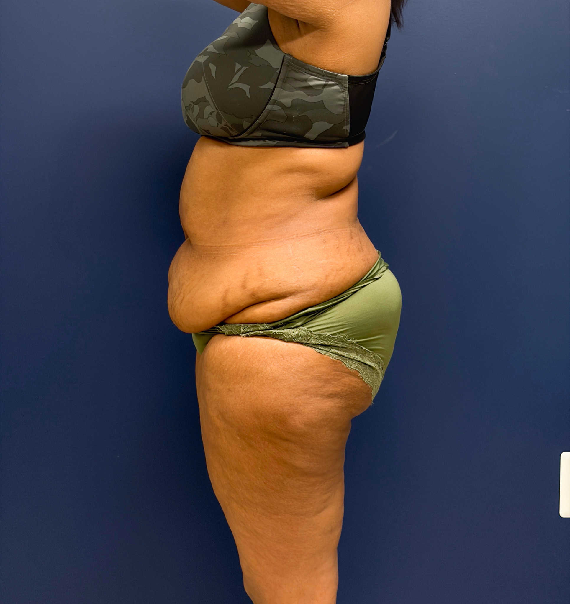 Lipoabdominoplasty-Case--6846 | Before Tummy Tuck 2