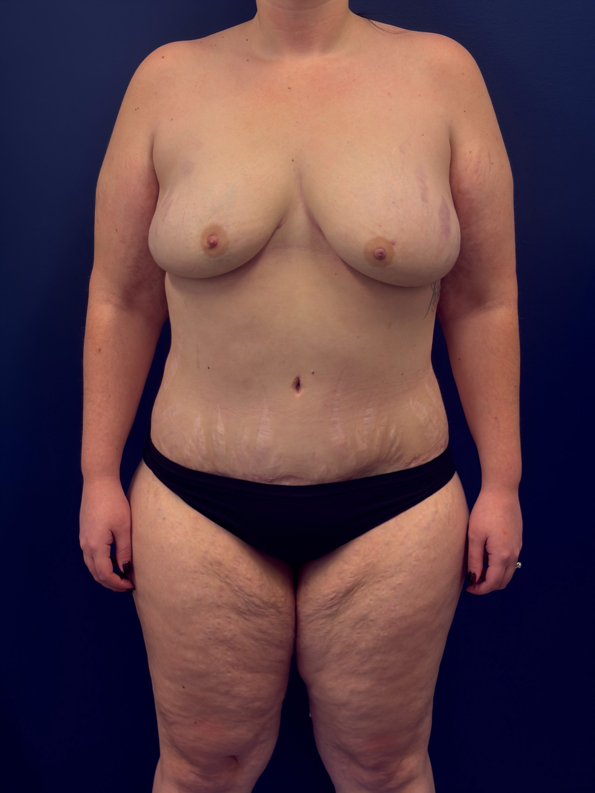 Bilateral-DIEP-Flap-Case--1108 | After Breast 1