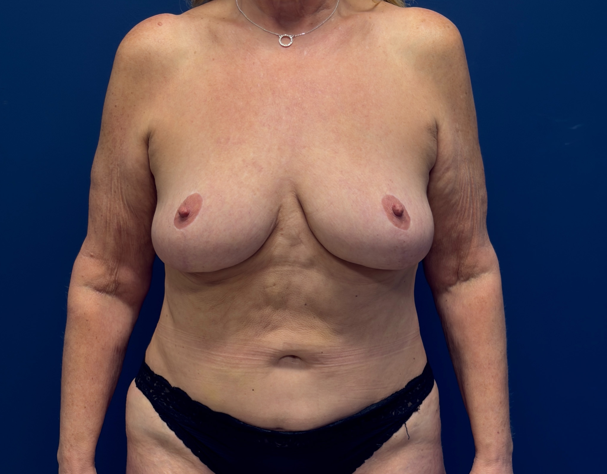 Preserv---Breast-Augmentation-Case--2946 | Before Breast 1