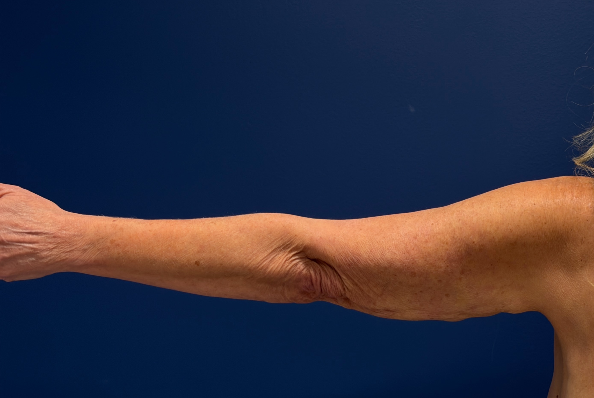 Brachioplasty-Case--4934 | Before Arm Lift 3