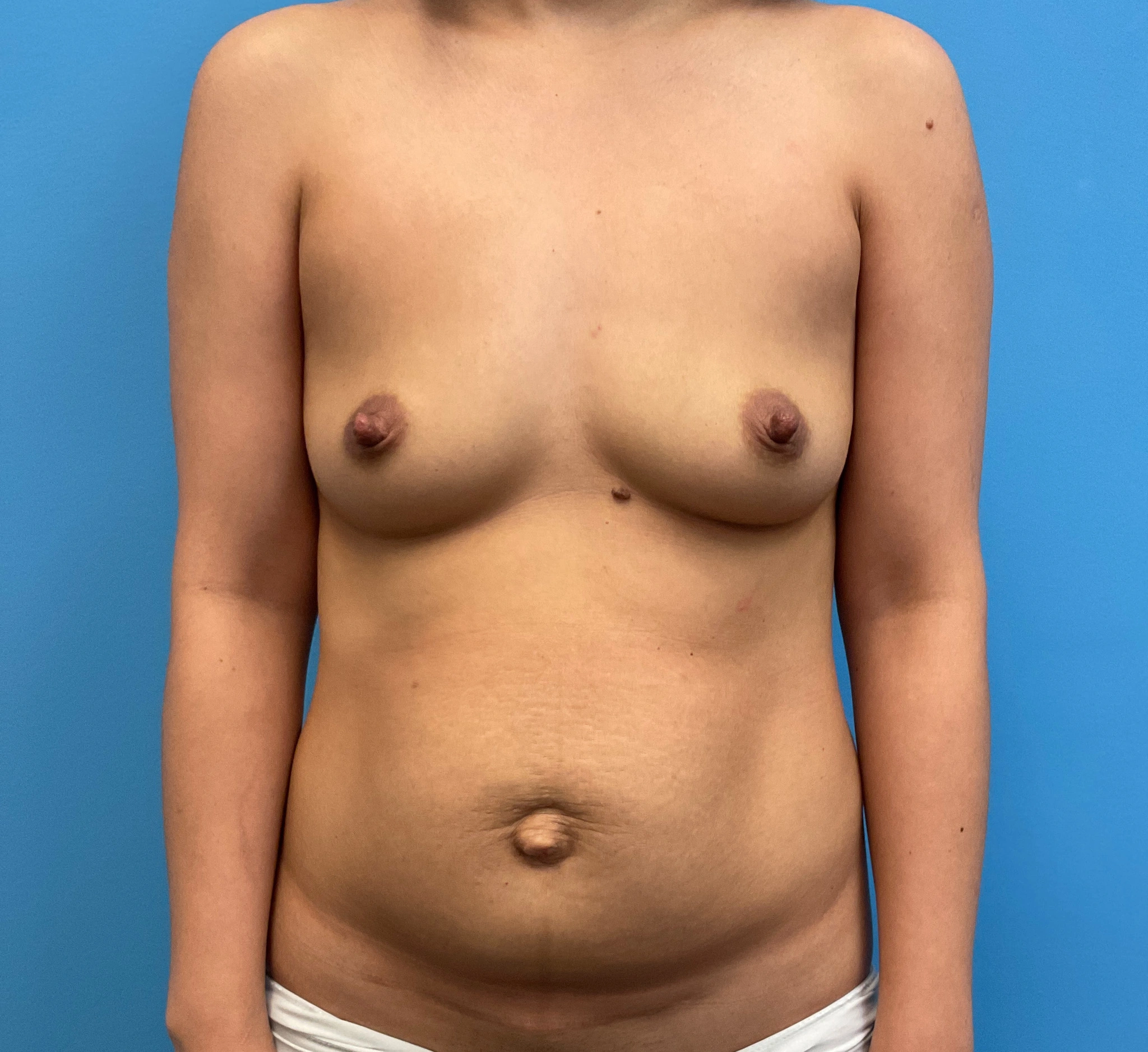 Breast-Augmentation-Case--4098 | Before Breast 1