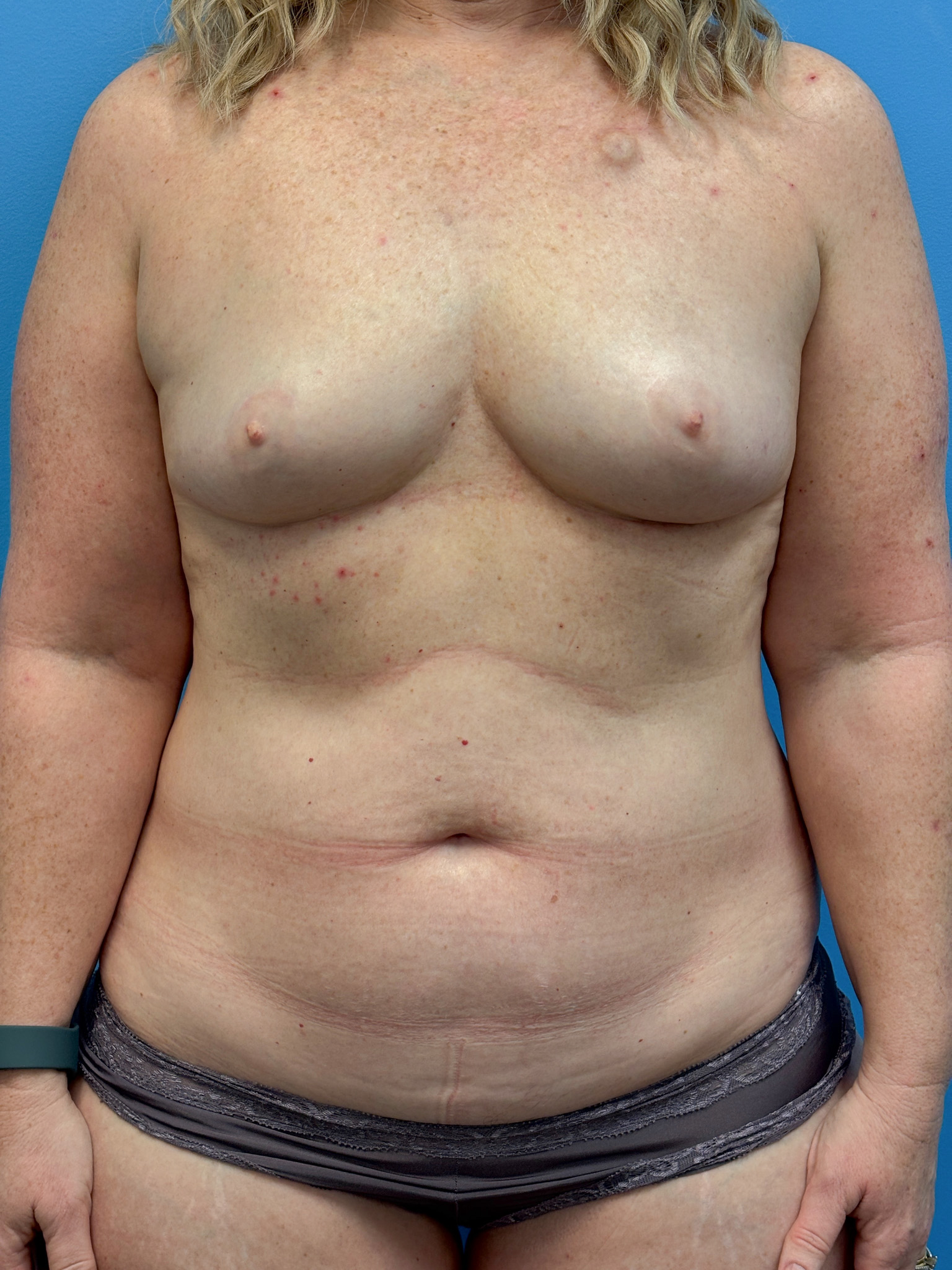 DIEP-Flap-Case--3138 | Before Breast 1