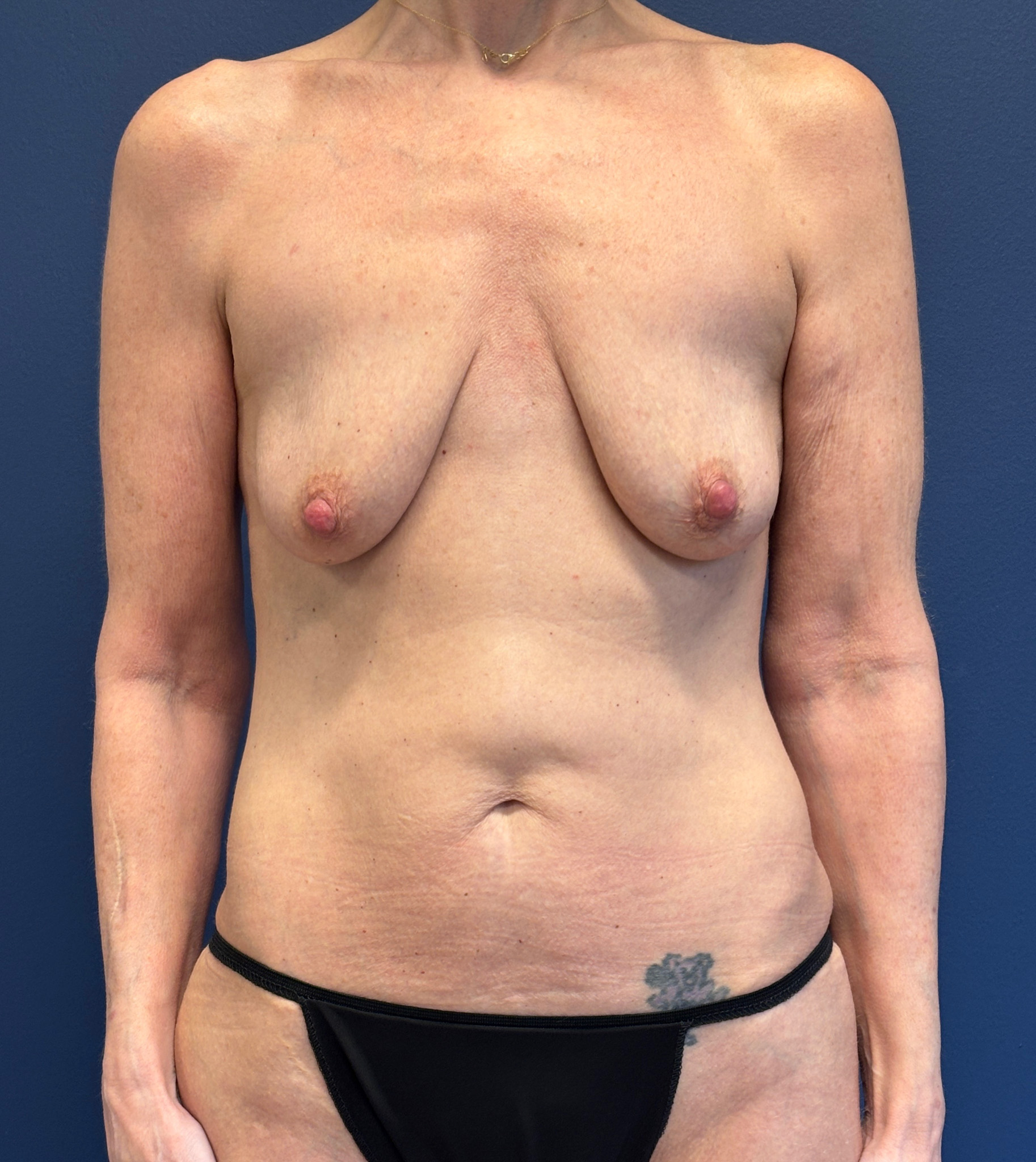 Augmentation-Mastopexy-Case--3055 | Before Breast 1