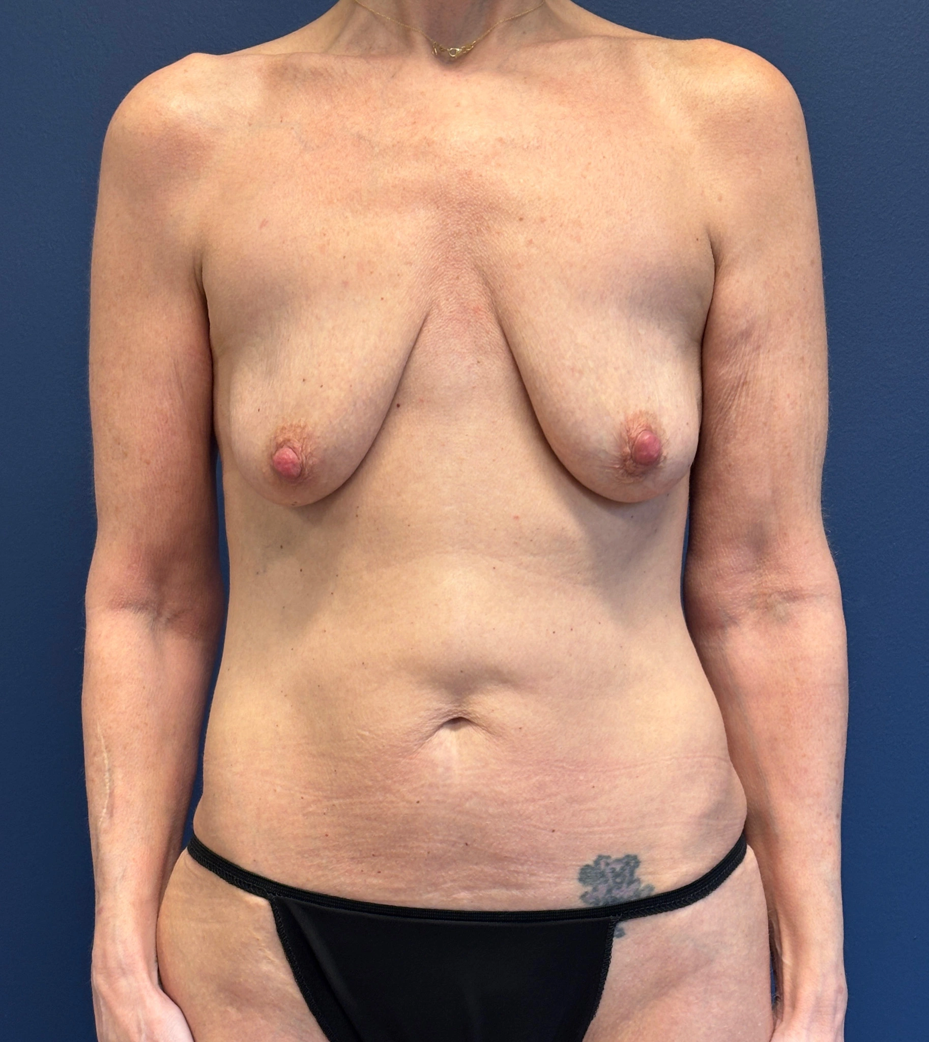 Augmentation-Mastopexy-Case--7491 | Before Breast 1