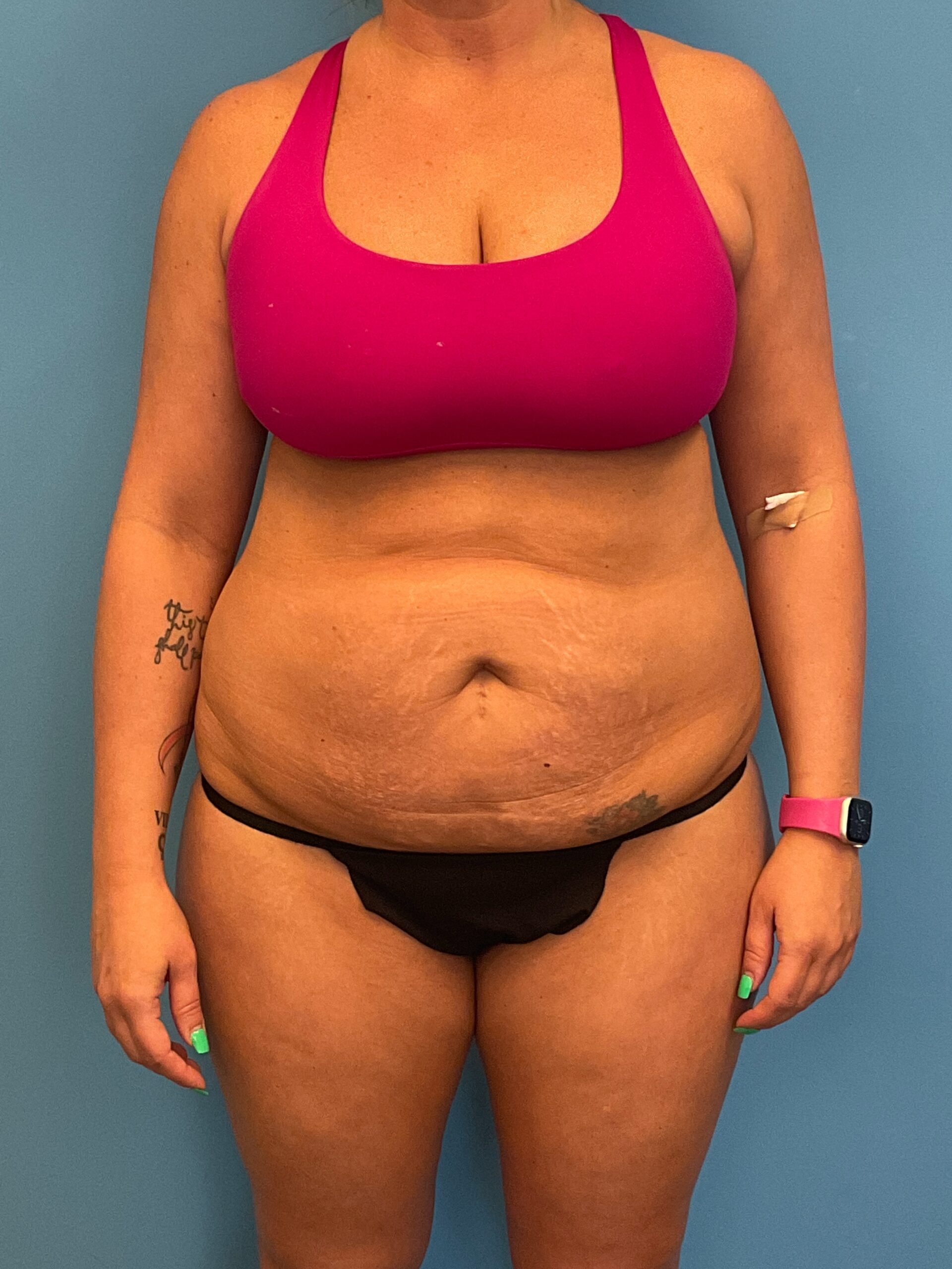 Abdominoplasty-Case--3117 | Before Tummy Tuck 1
