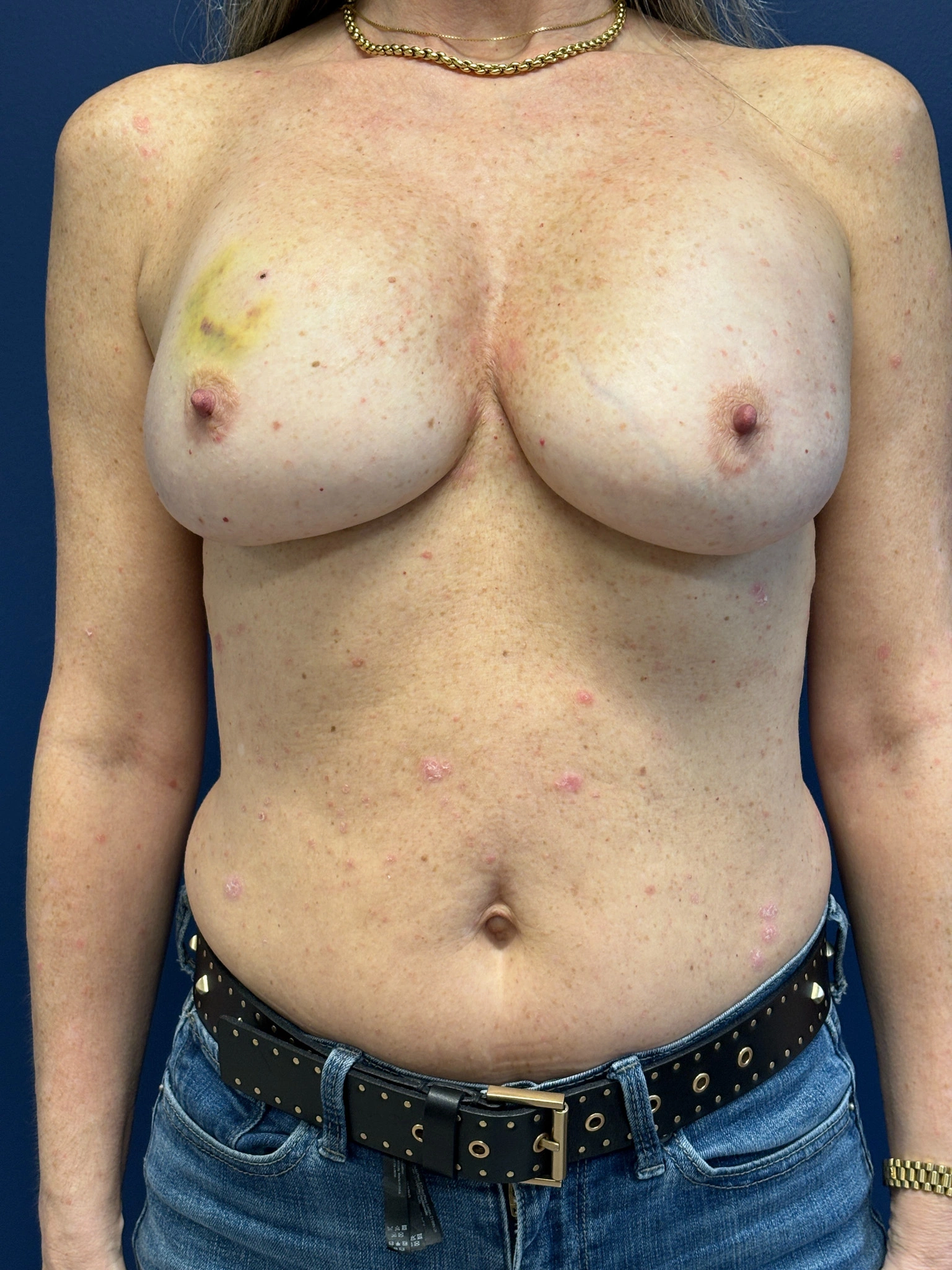 Breast-Reconstruction-Case--8978 | Before Breast 1