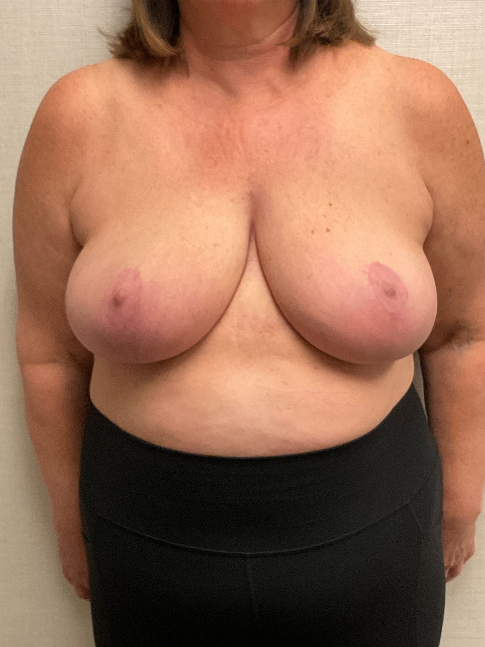 Breast-Reduction-Case--26425 | After Breast 1