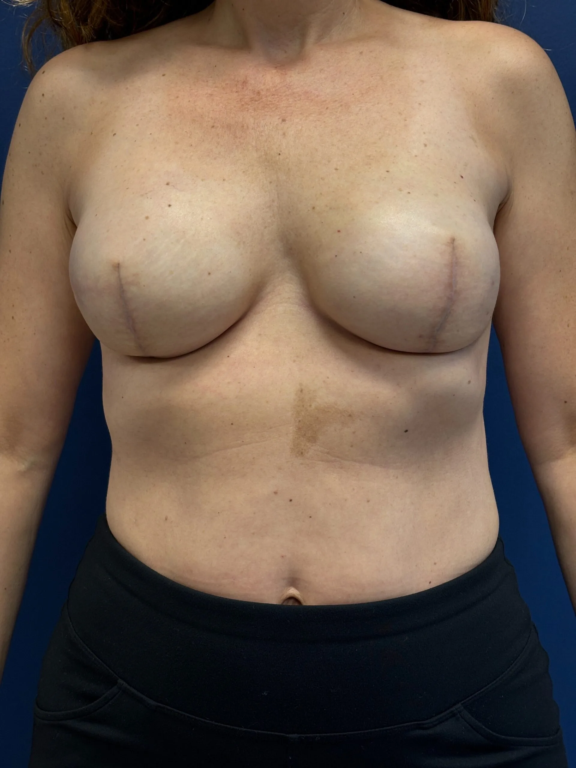 Breast-Reconstruction-Case--6069 | After Breast 1