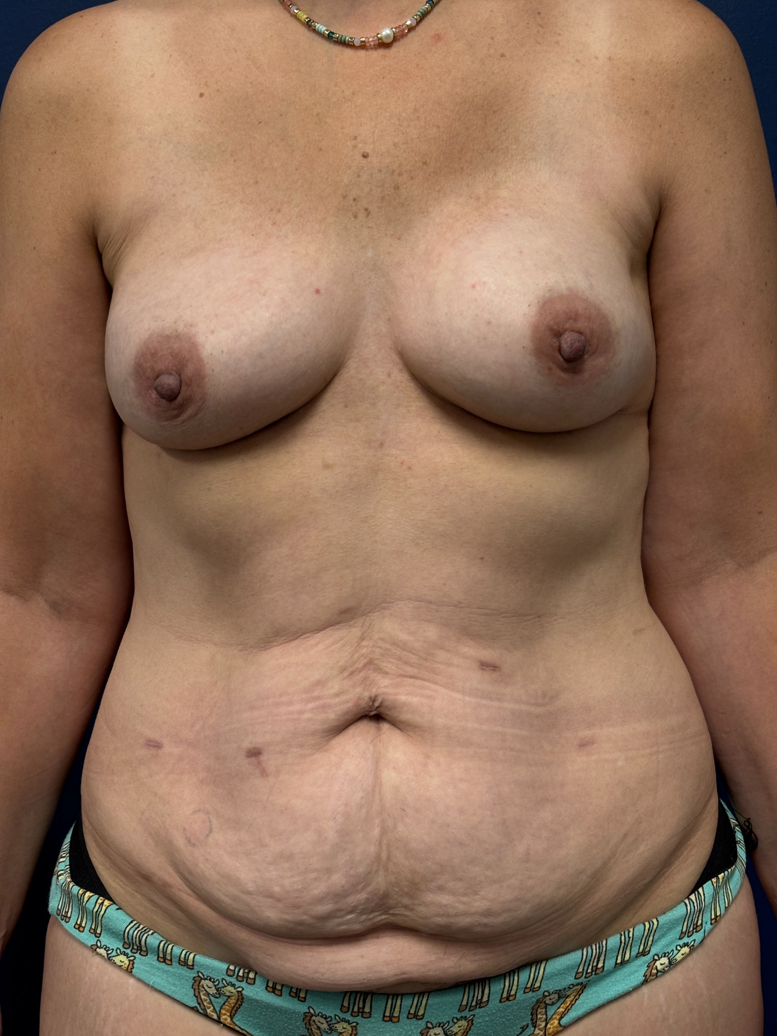 DIEP-Flap-Case--6167 | Before Breast 1