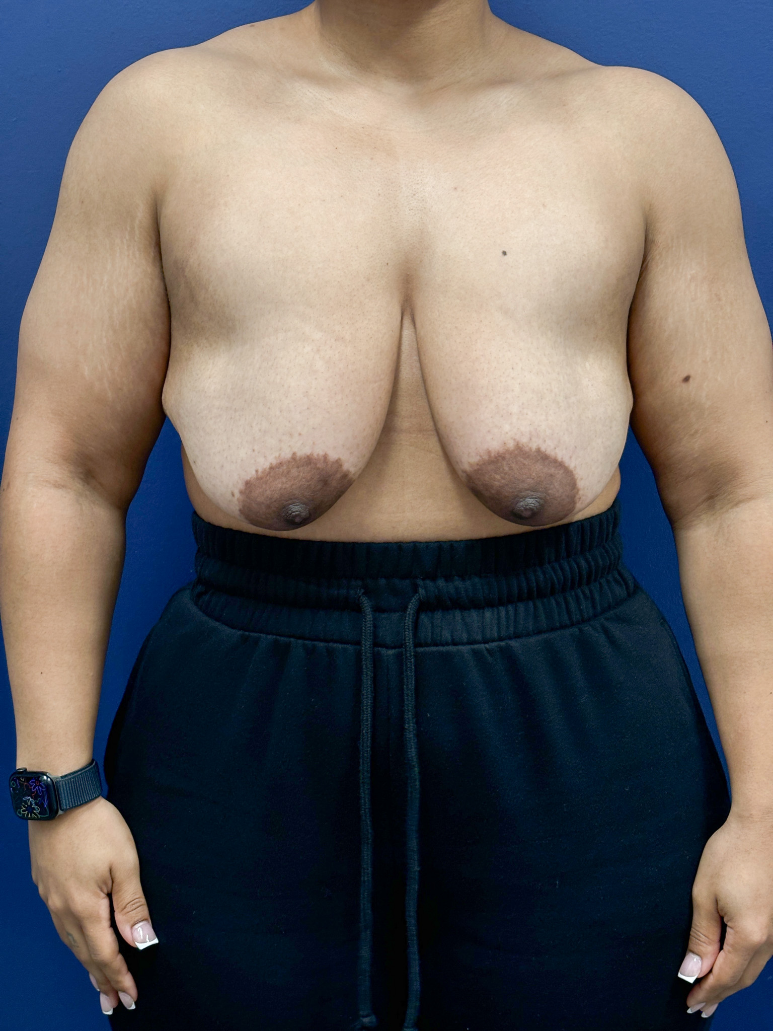 Breast-Reduction-Case--7345 | Before Breast 1