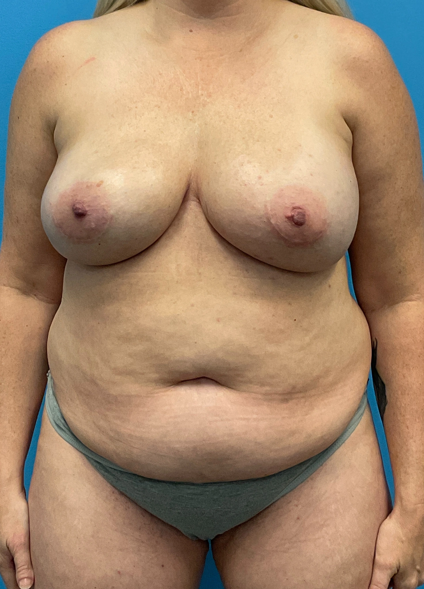 DIEP-Flap-Case--2056 | Before Breast 1