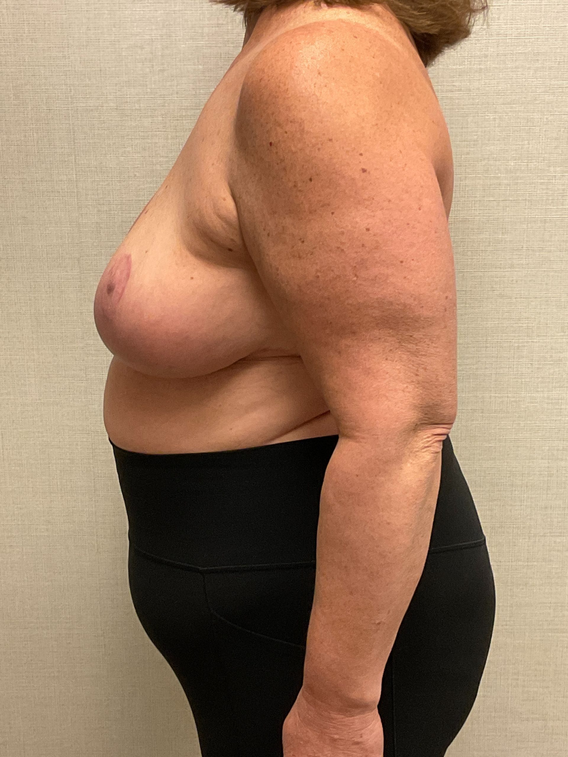 Breast-Reduction-Case--26425 | After Breast 2