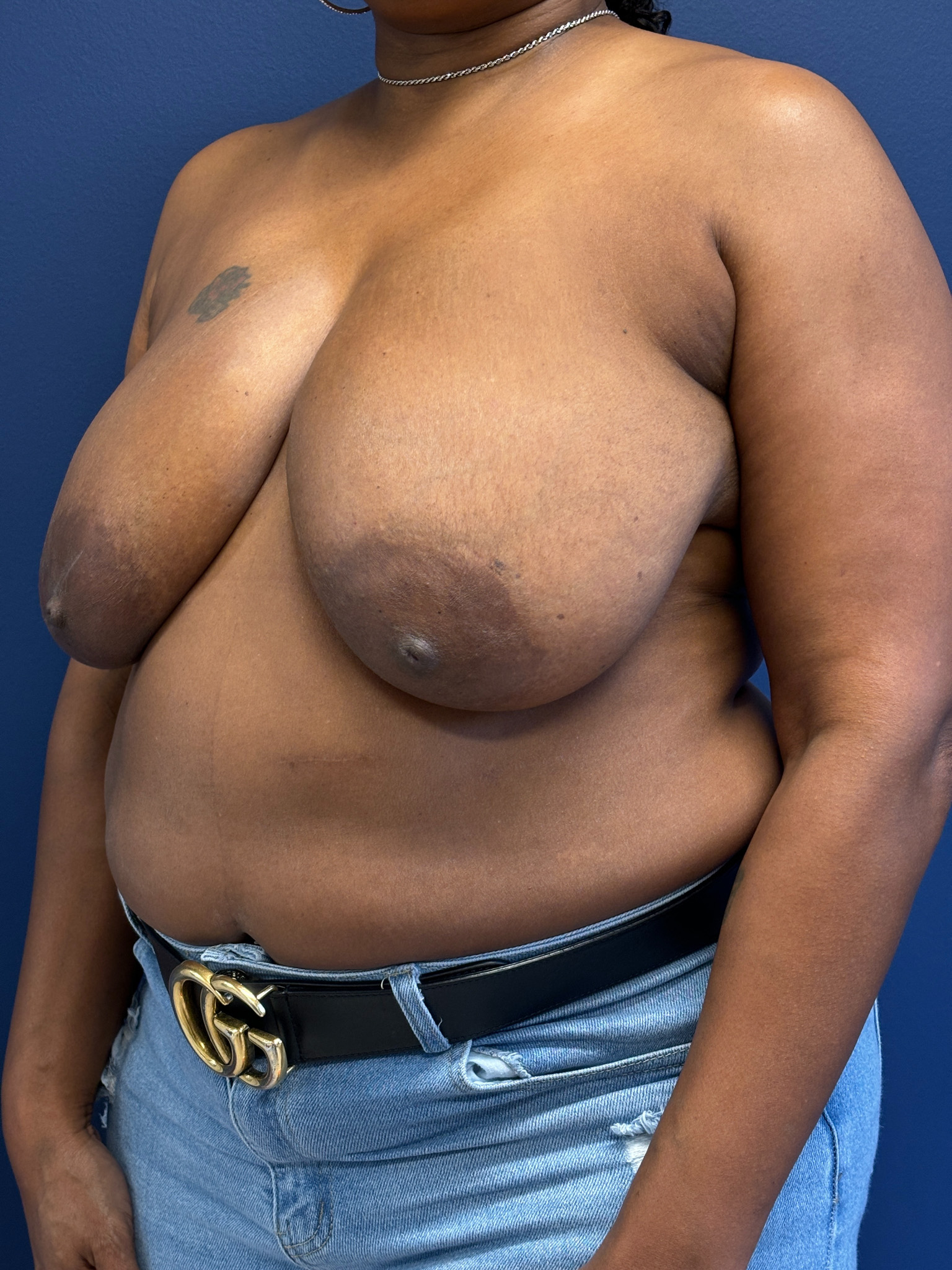 Breast-Reduction-Case--4053 | Before Breast 2