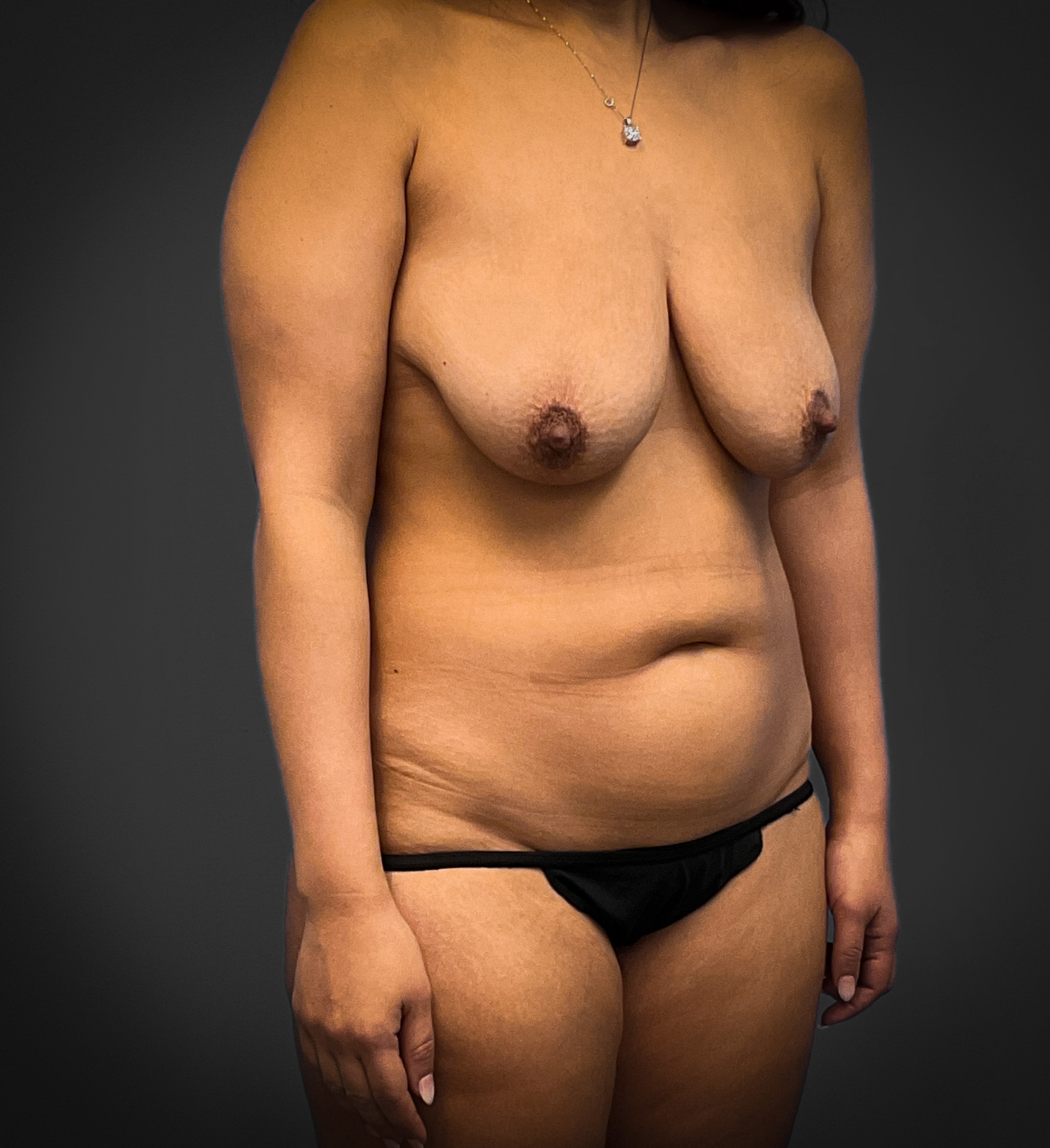 Augmentation-Mastopexy-Case--2371 | Before Breast Lift 5
