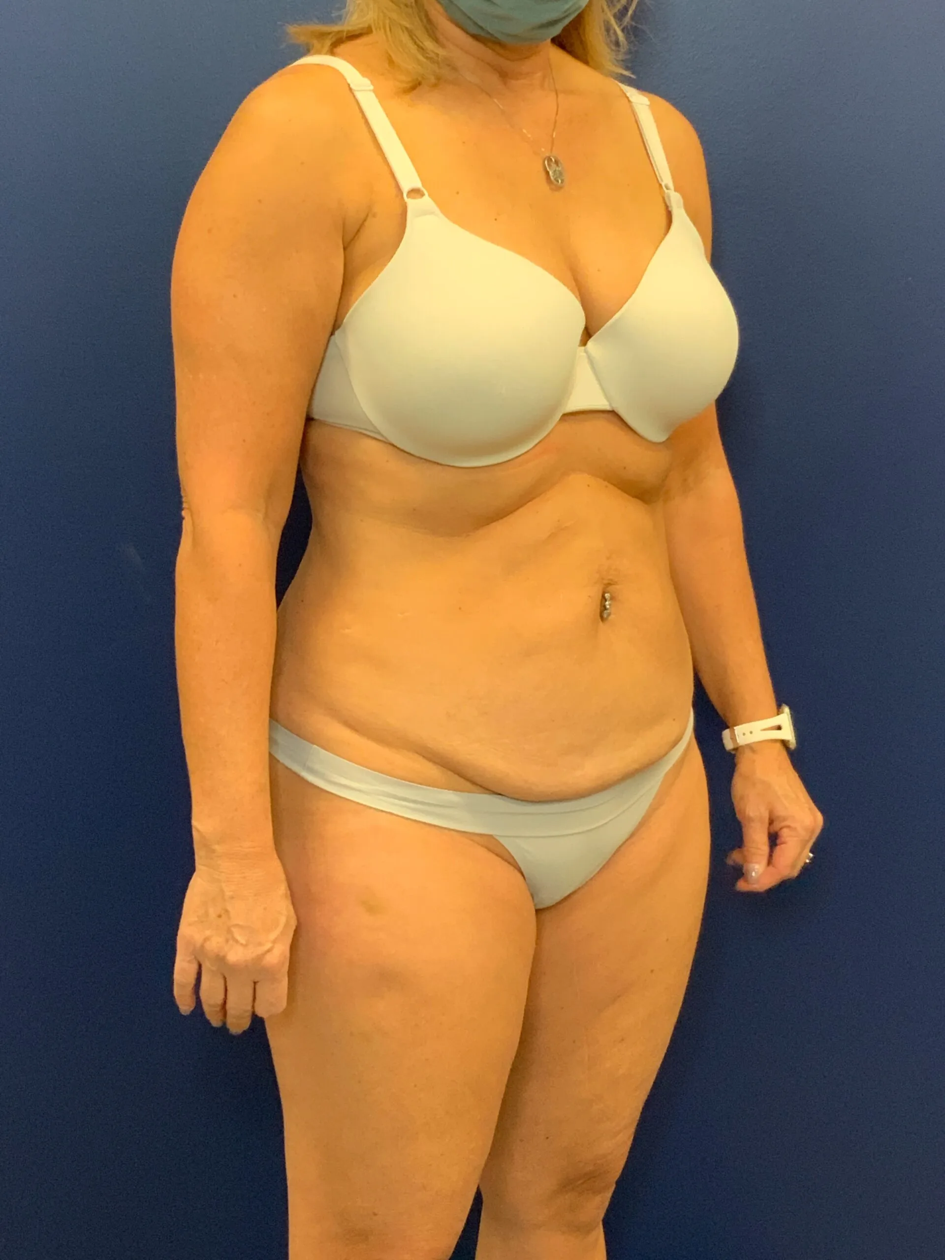 Abdominoplasty-Case--7924 | Before Tummy Tuck 3