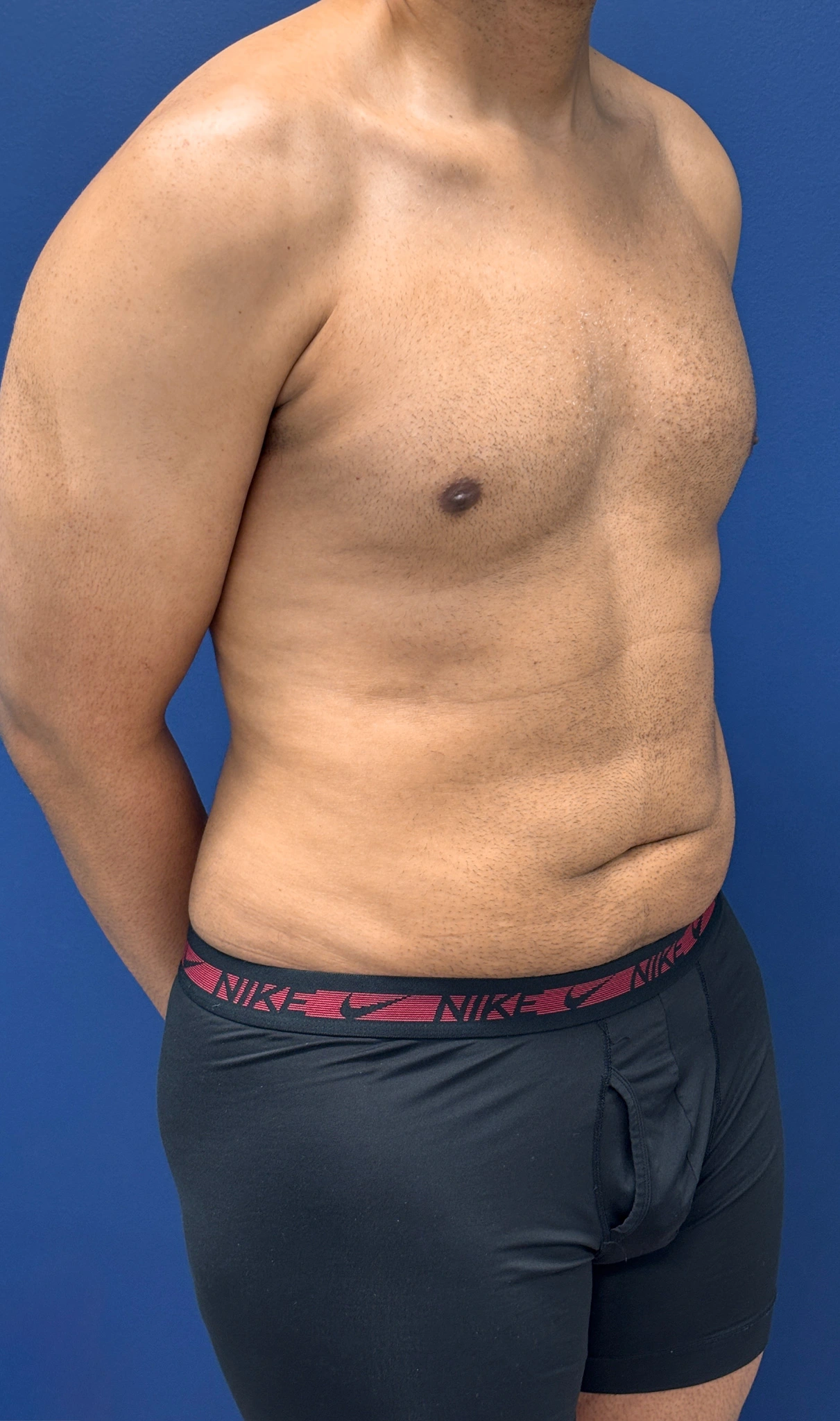 Lipo-360-Case--4979 | After Liposuction 4