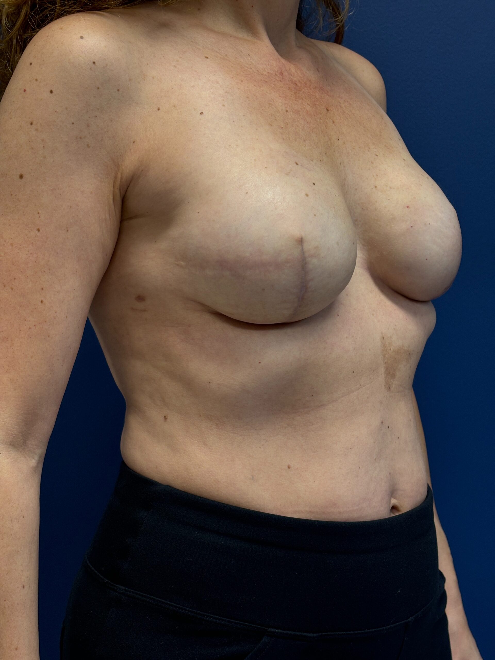 Breast-Reconstruction-Case--6069 | After Breast 2