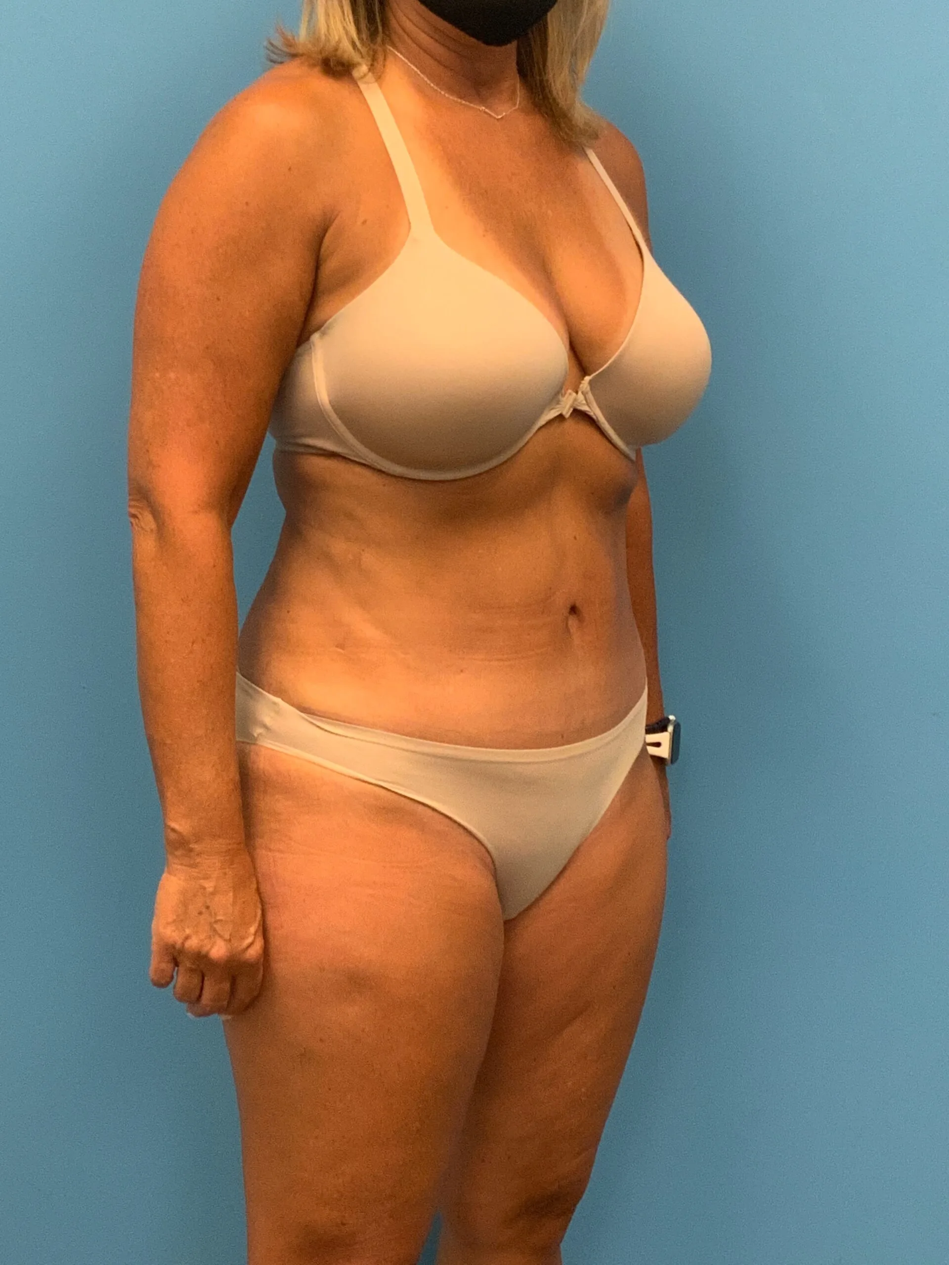 Abdominoplasty-Case--7924 | After Tummy Tuck 3