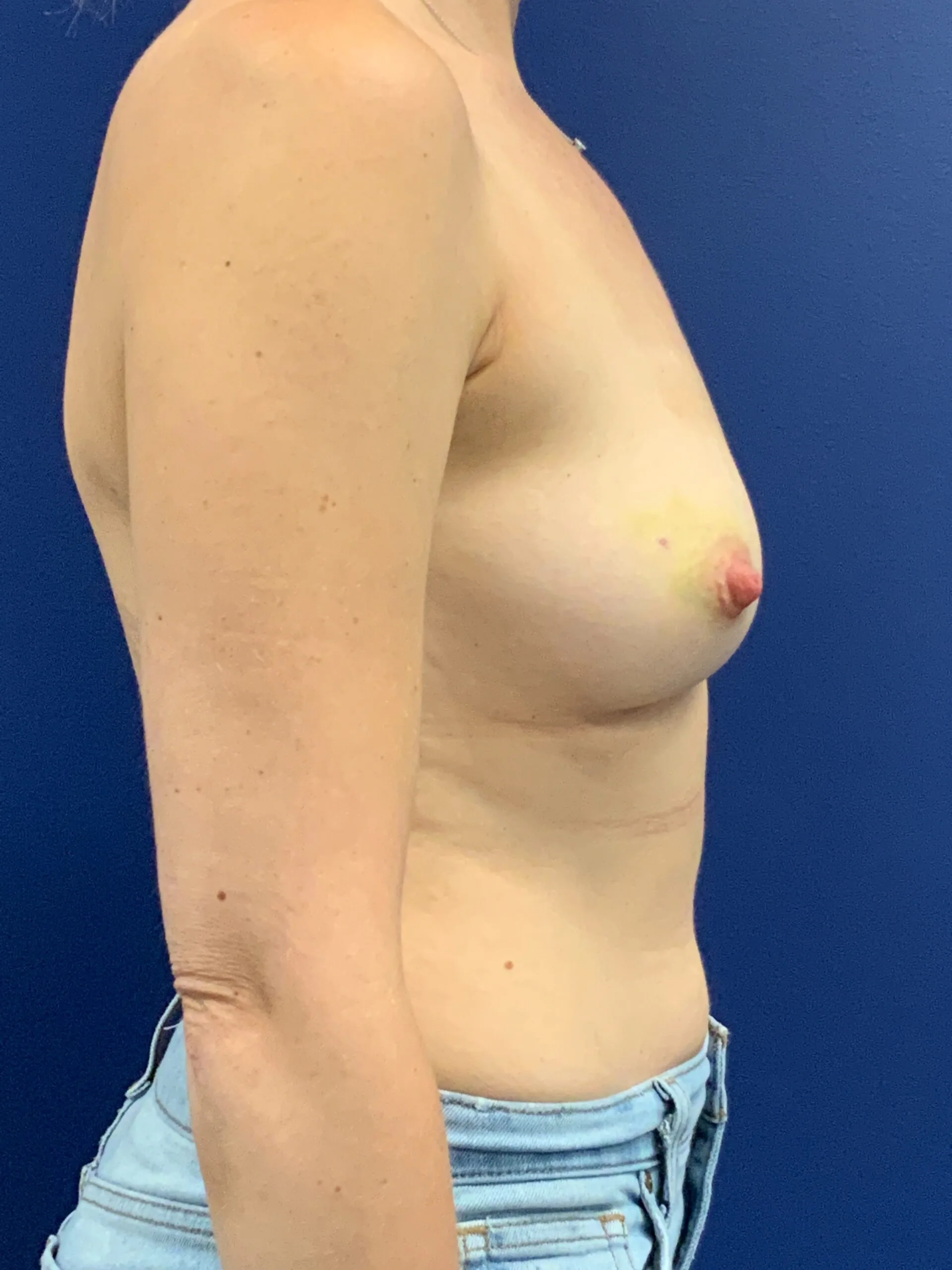 Breast-Reconstruction-Case--7867 | Before Breast 2