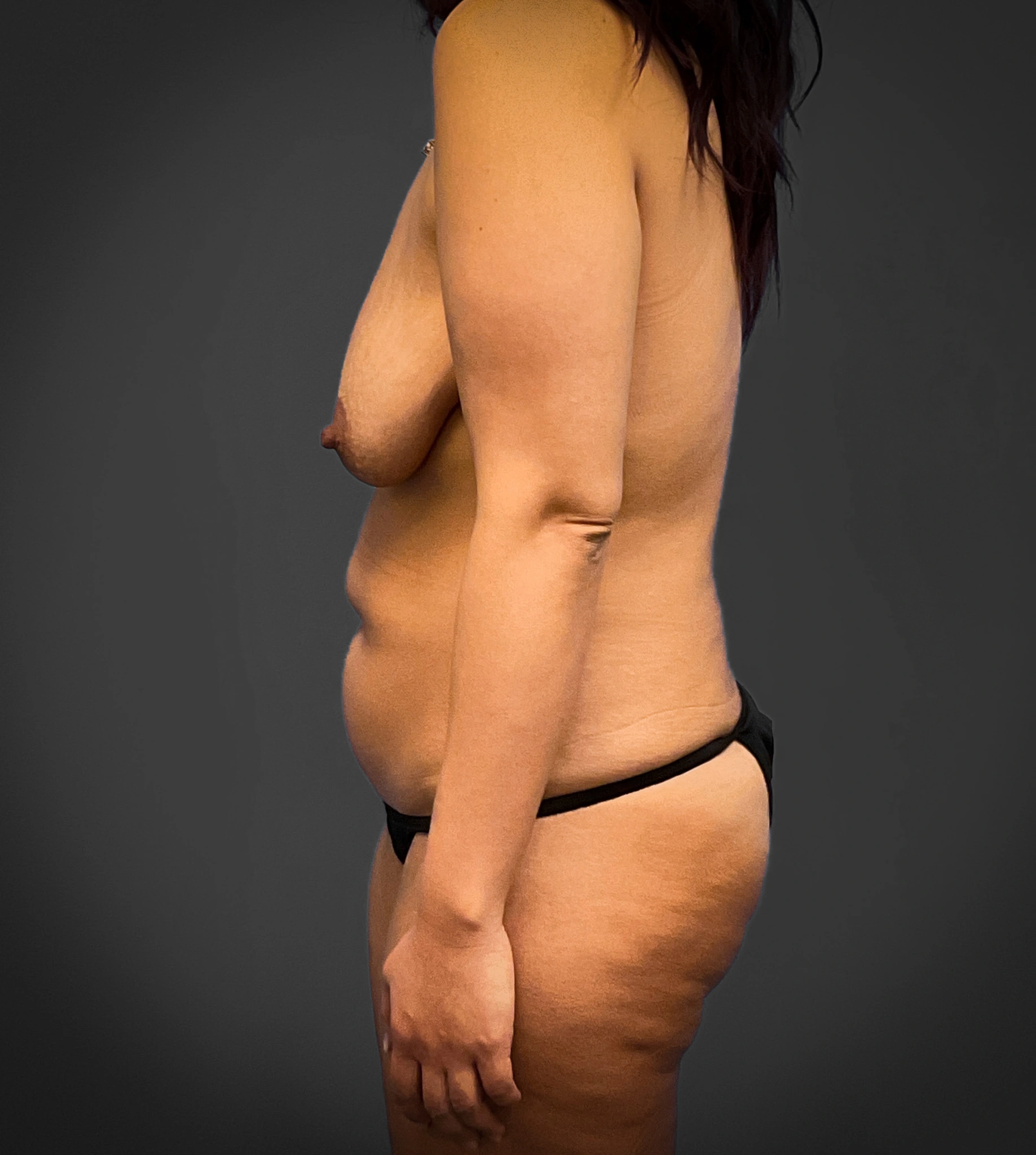 Augmentation-Mastopexy-Case--2371 | Before Breast 2