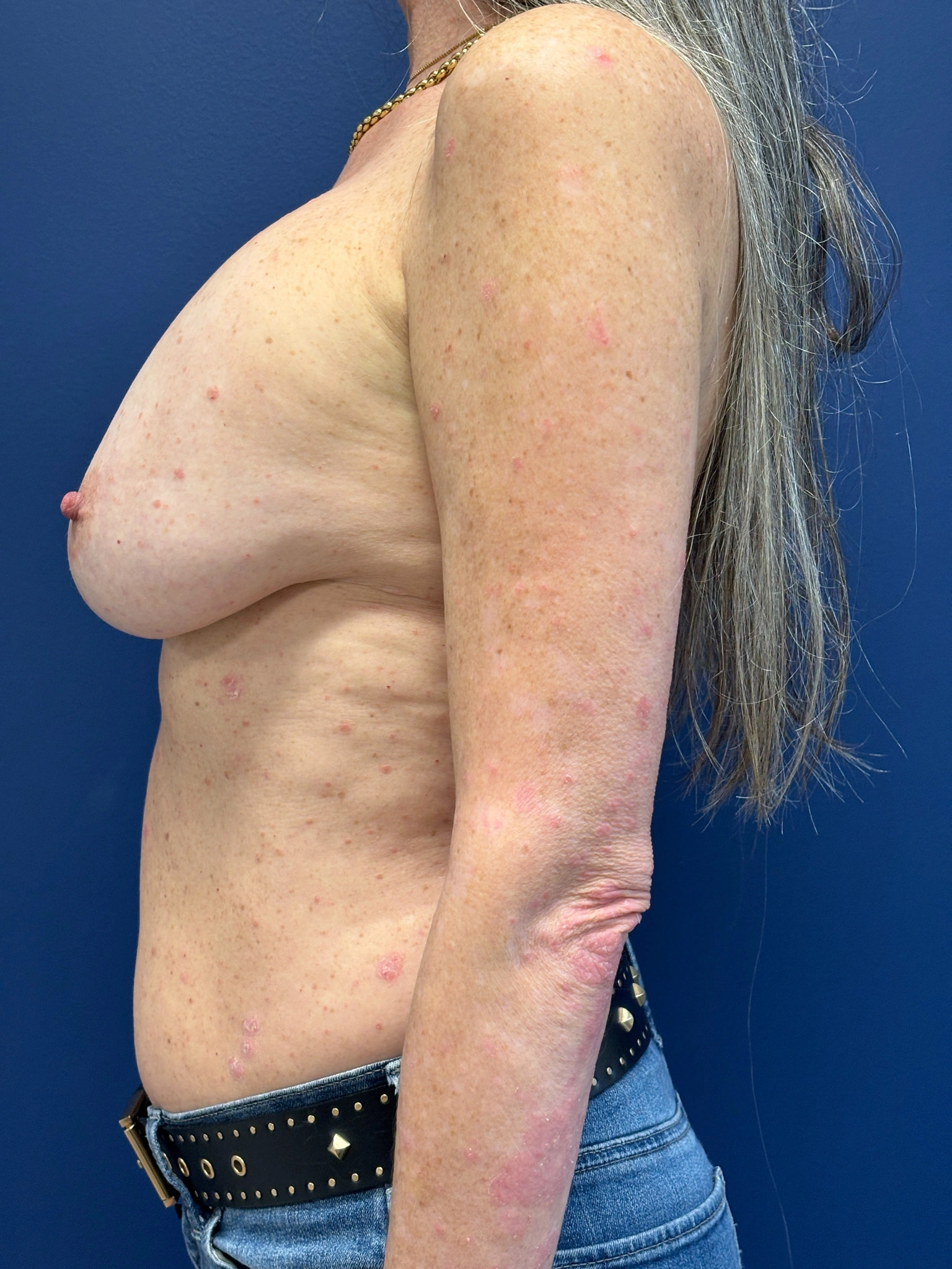 Breast-Reconstruction-Case--8978 | Before Breast 2