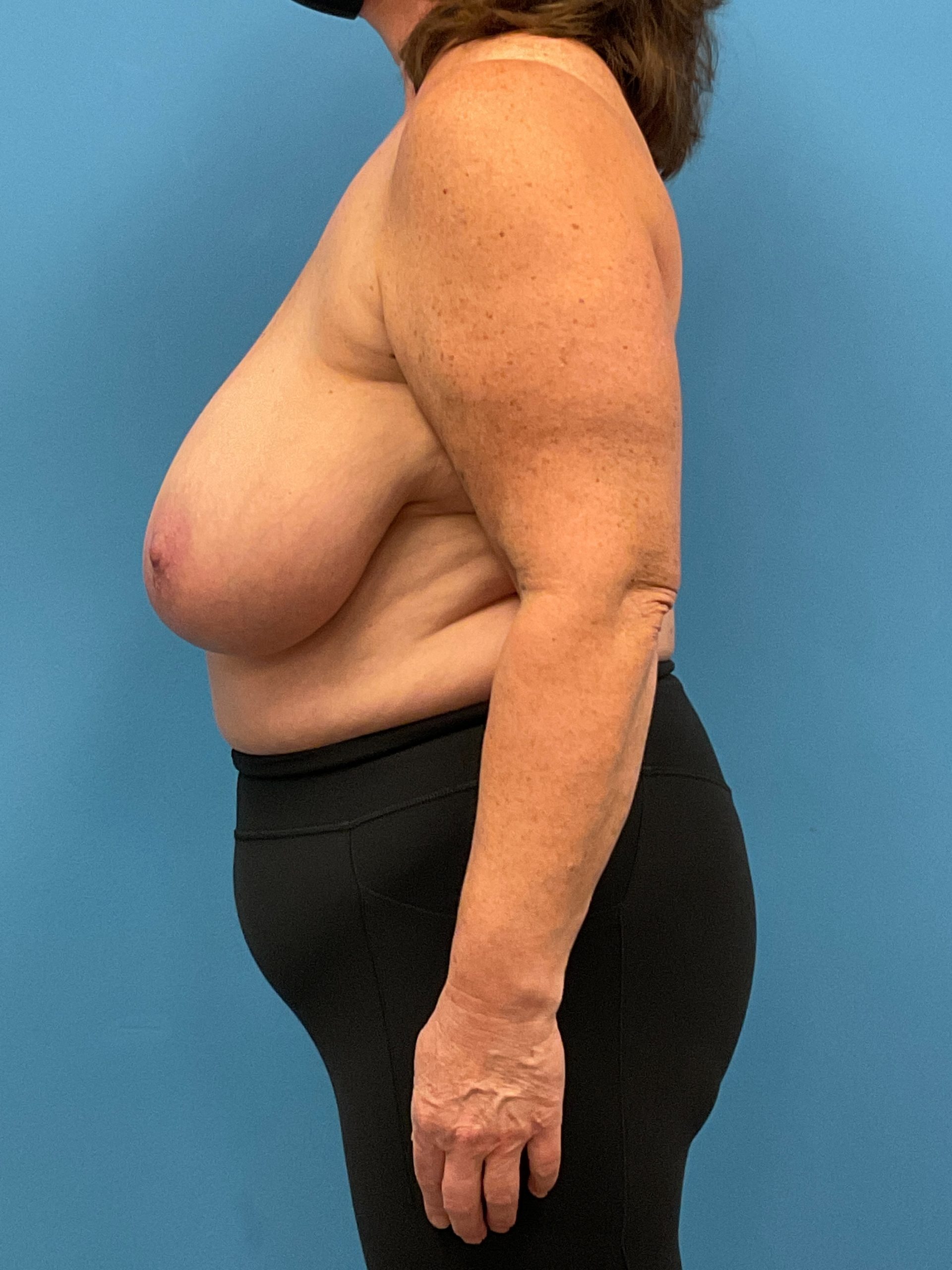 Breast-Reduction-Case--26425 | Before Breast 2