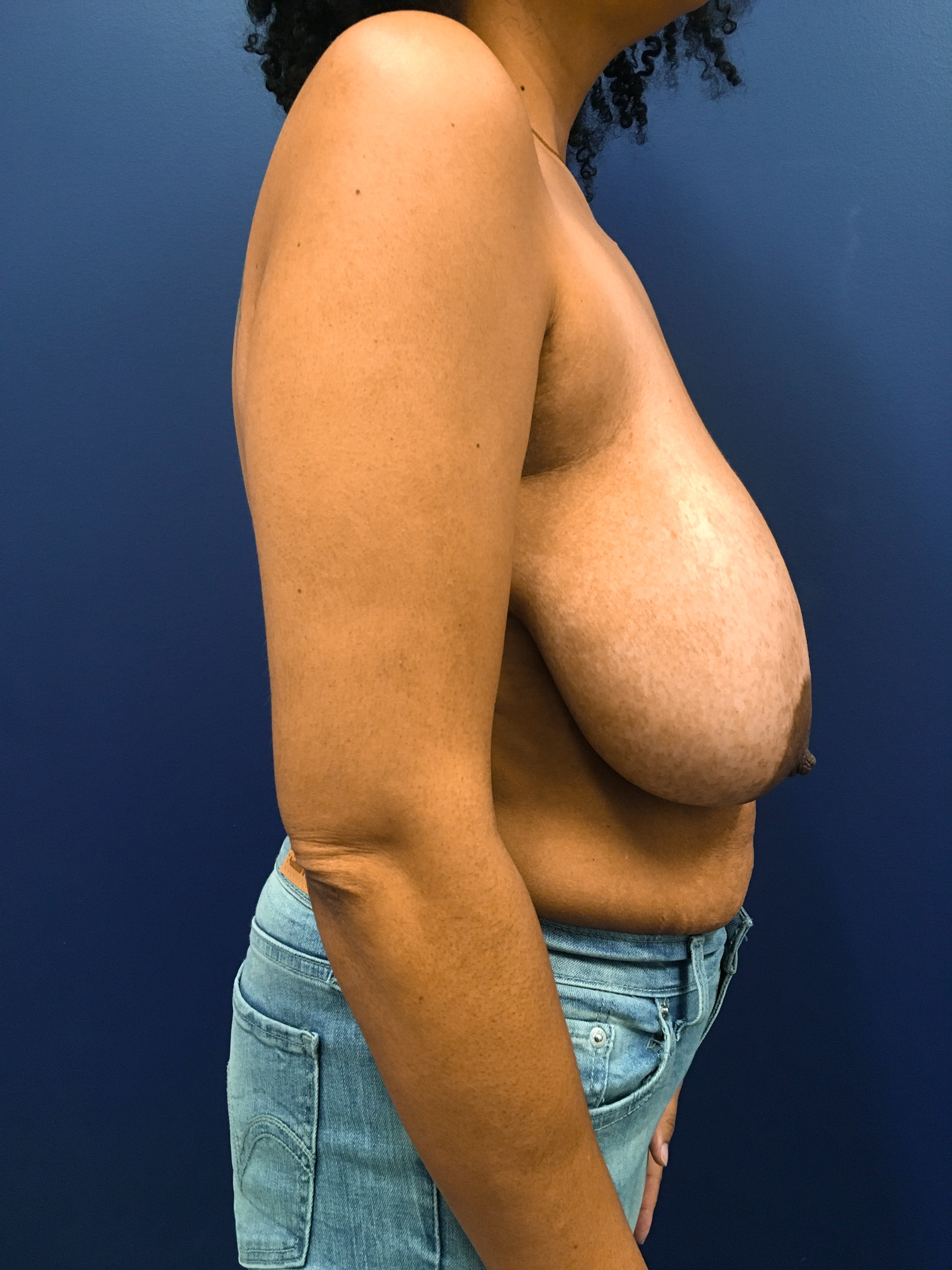 Breast-Reduction-Case--4484 | Before Breast 2