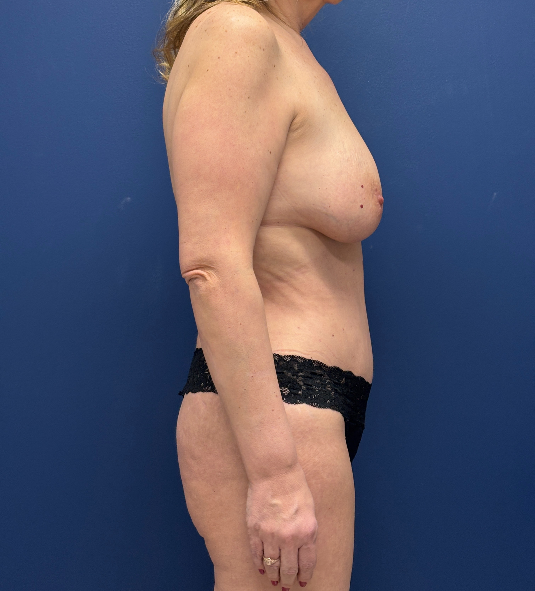 Abdominoplasty-Case--9829 | After Tummy Tuck 3