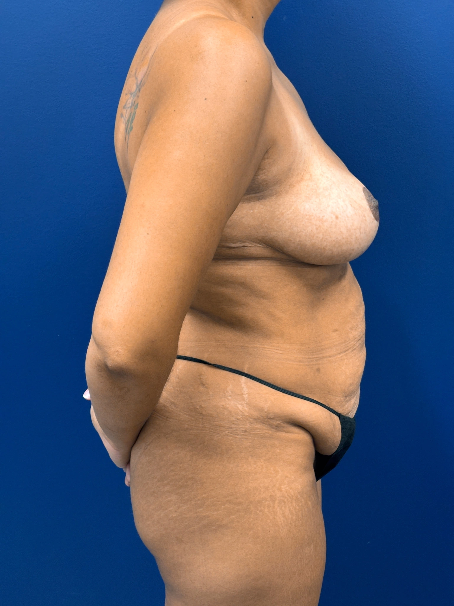 Breast-Reduction-Case--4484 | After Breast 2
