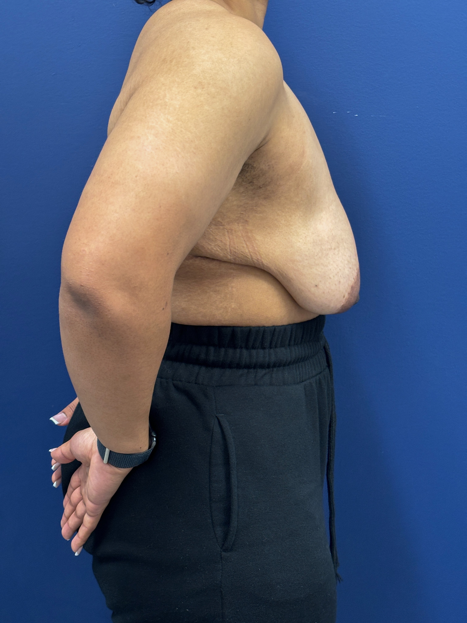 Breast-Reduction-Case--7345 | Before Breast 2