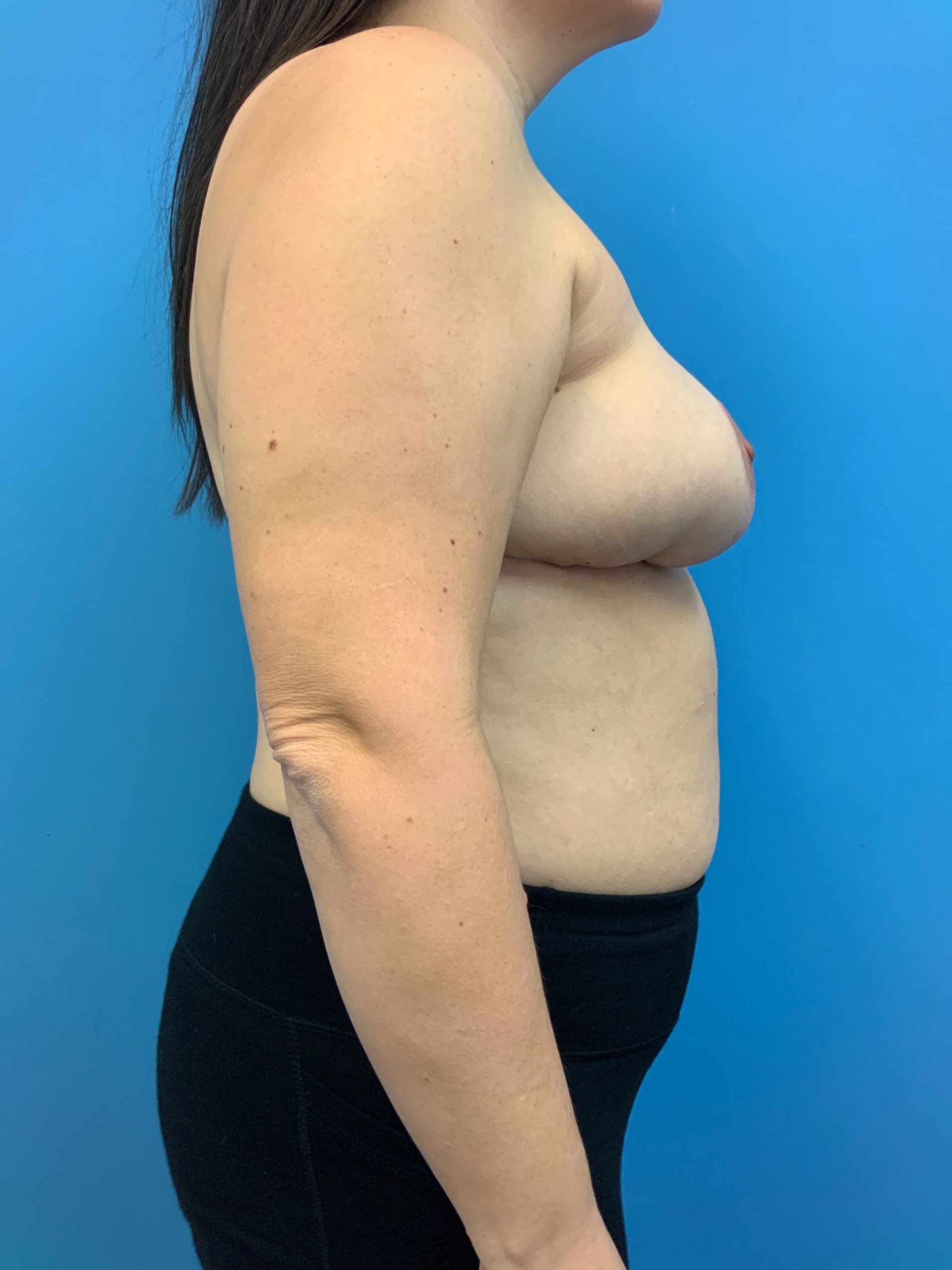Breast-Reconstruction-Case--6507 | After Breast 2
